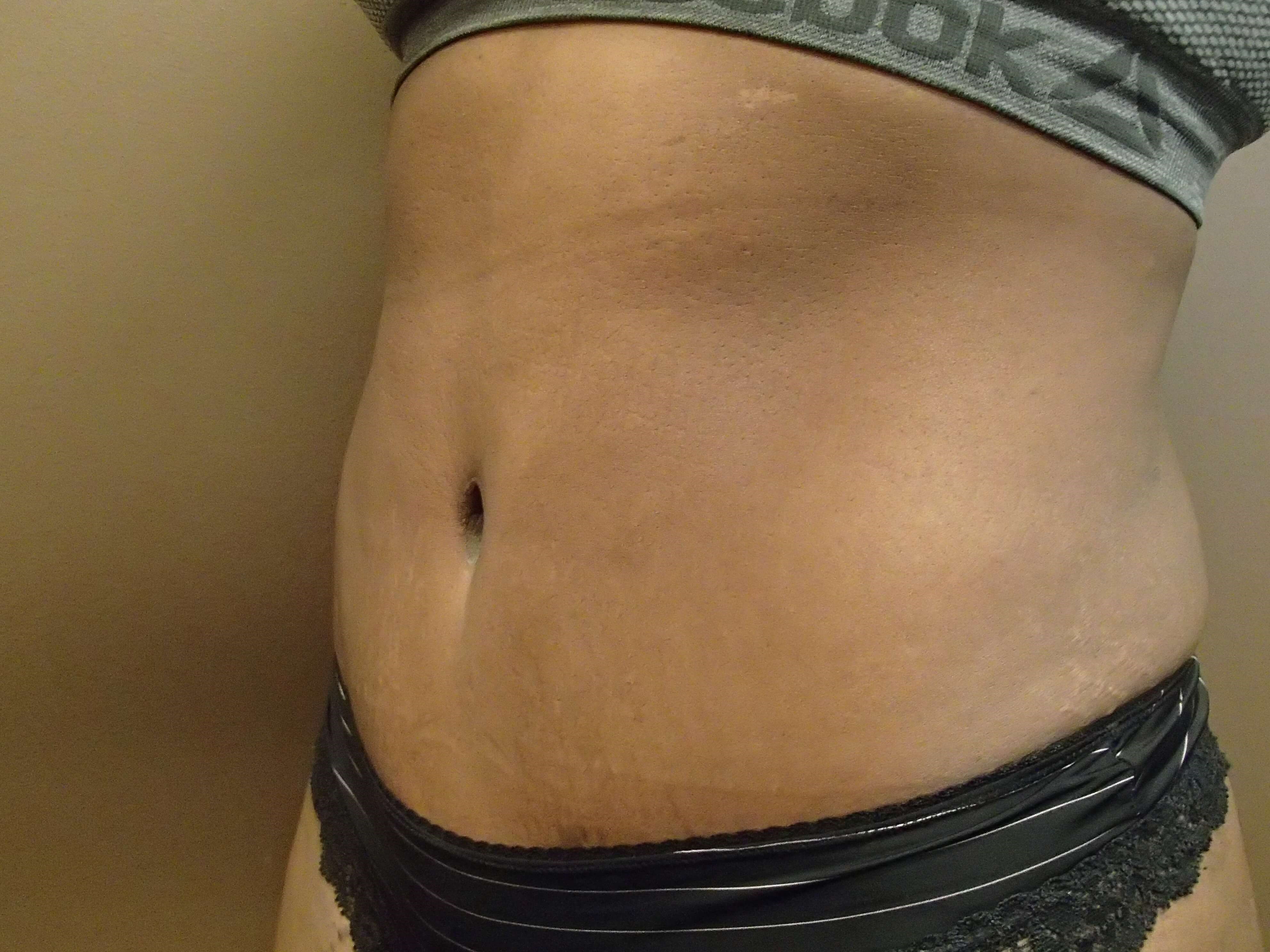 Timeless Tuck Oblique View After