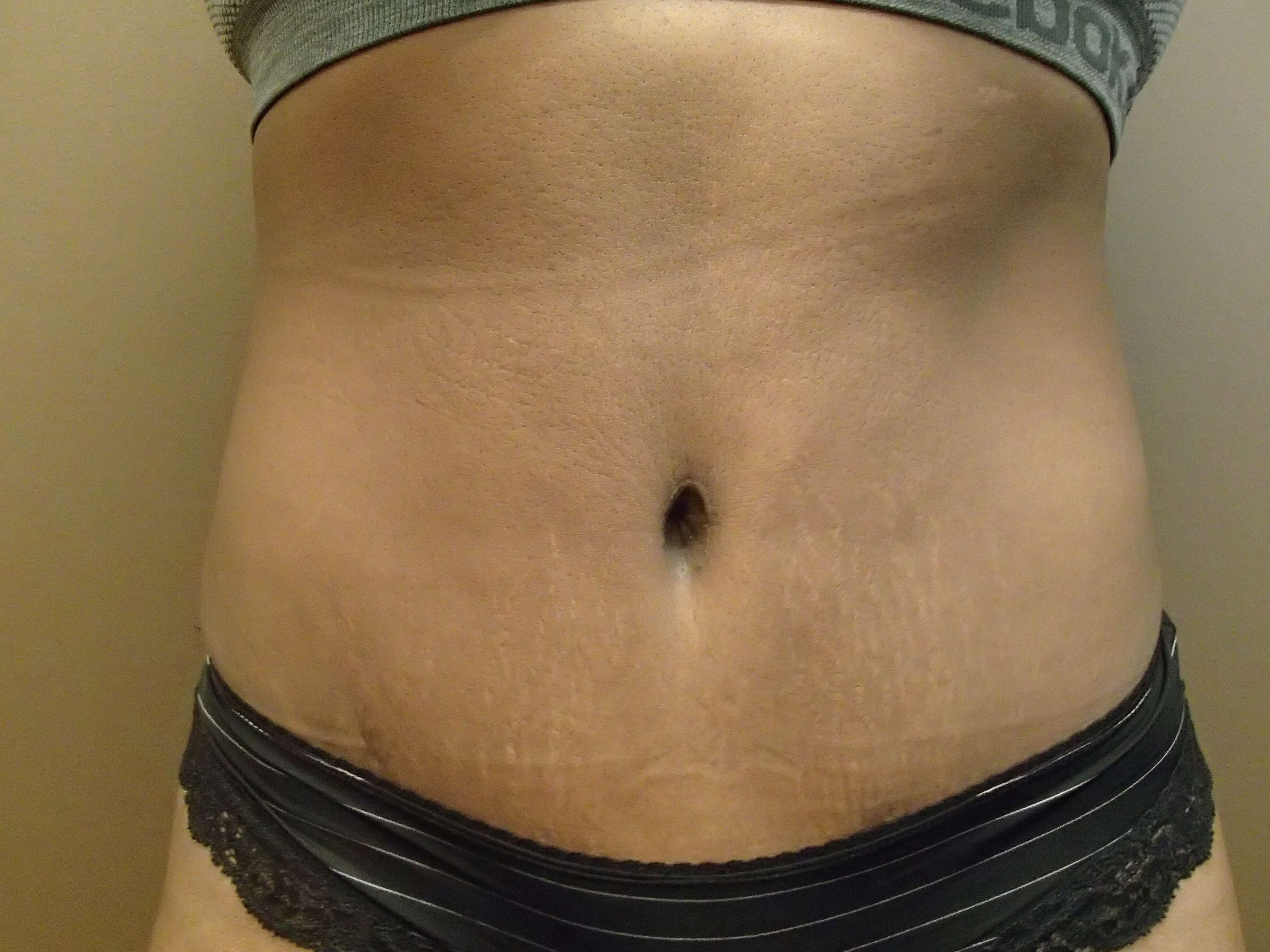 Timeless Tuck Front View After