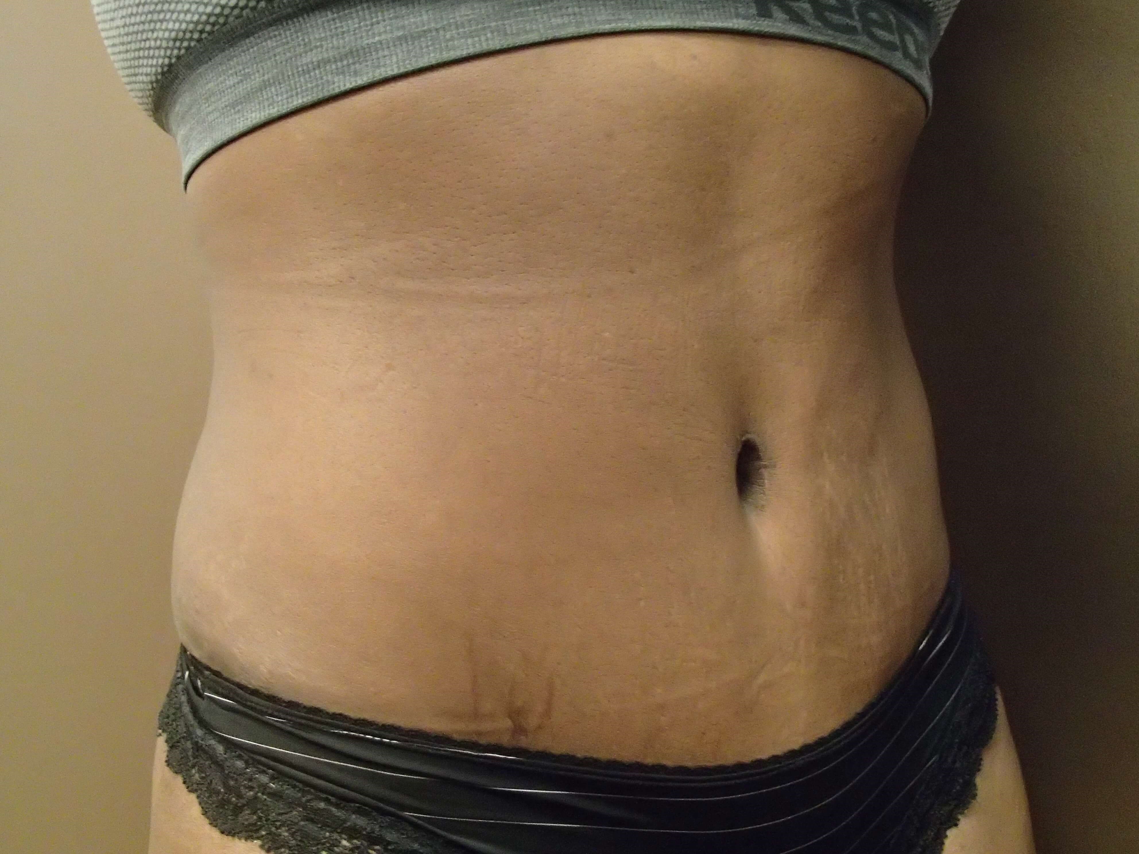Timeless Tuck Oblique View After
