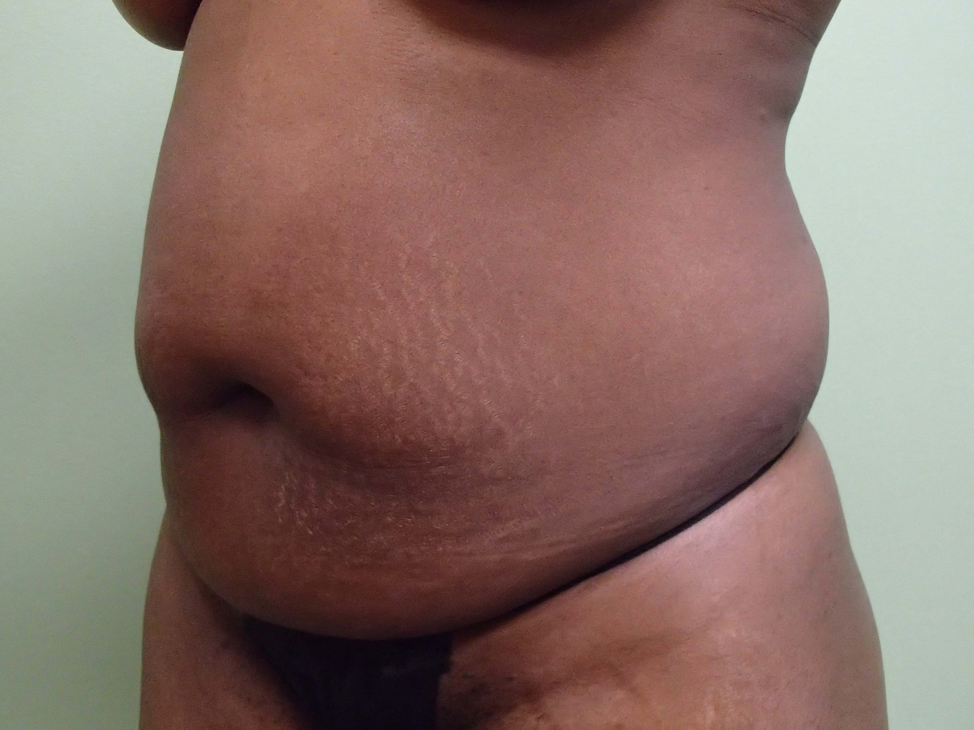 Timeless Tuck Oblique View Before