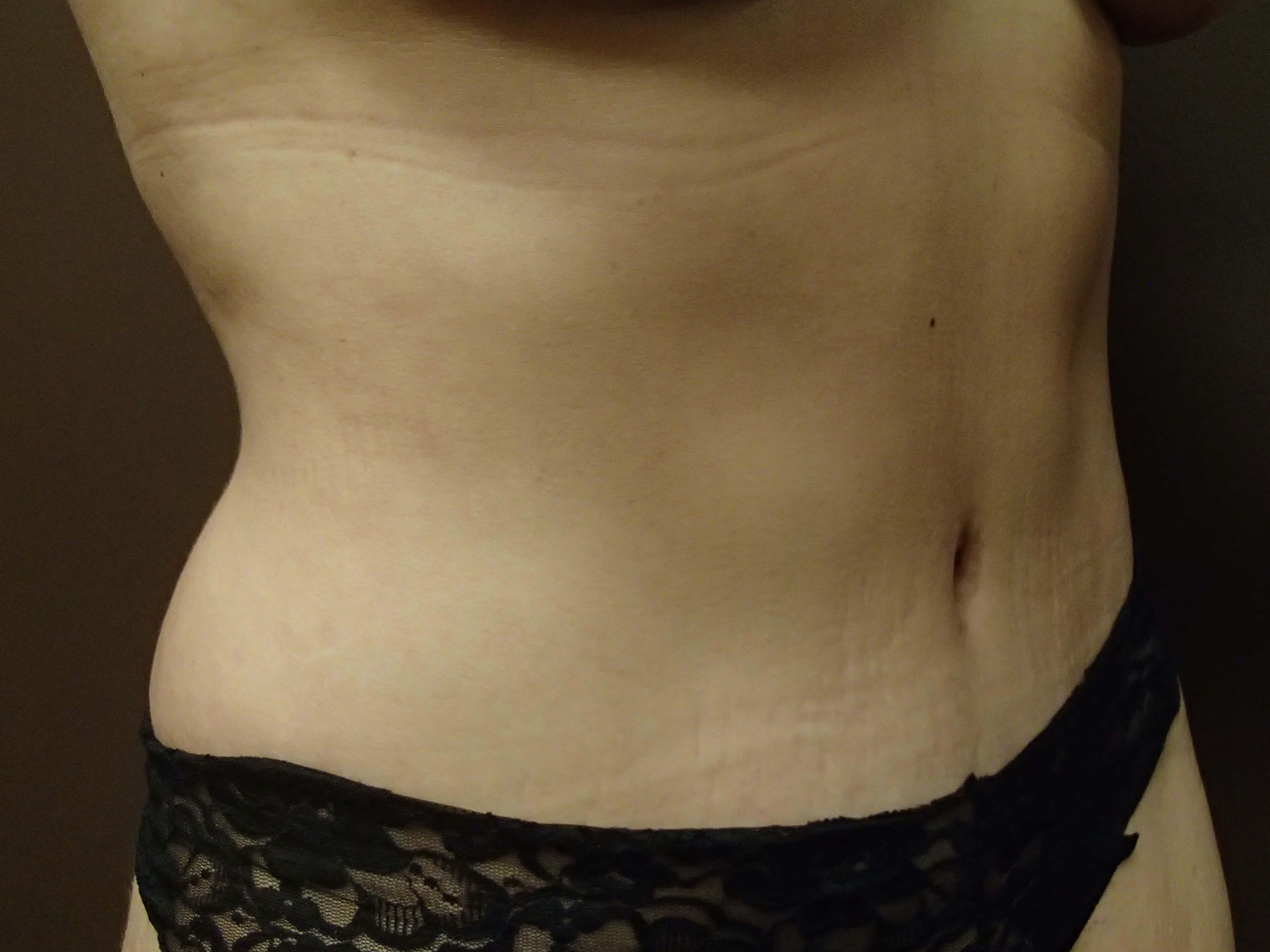 Timeless Tuck Oblique View After