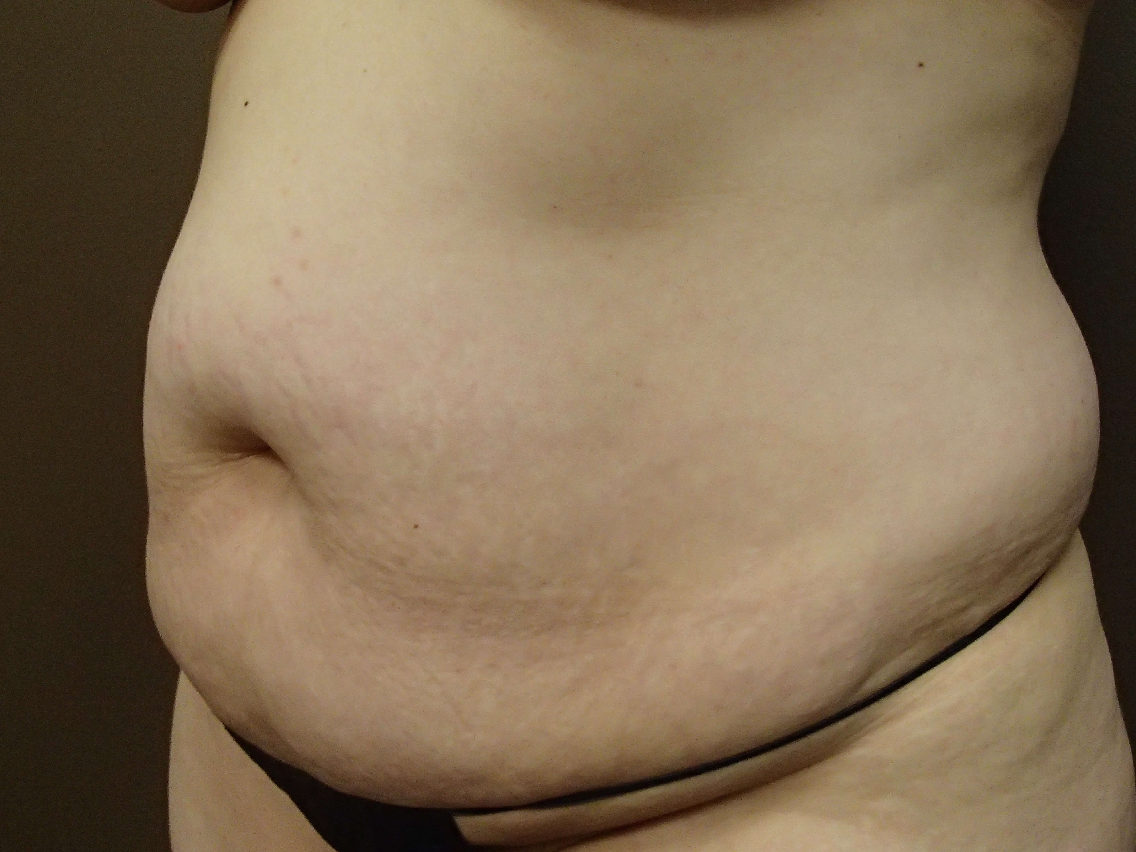 Timeless Tuck Oblique View Before