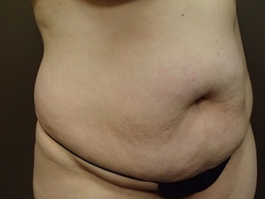 Timeless Tuck Oblique View Before