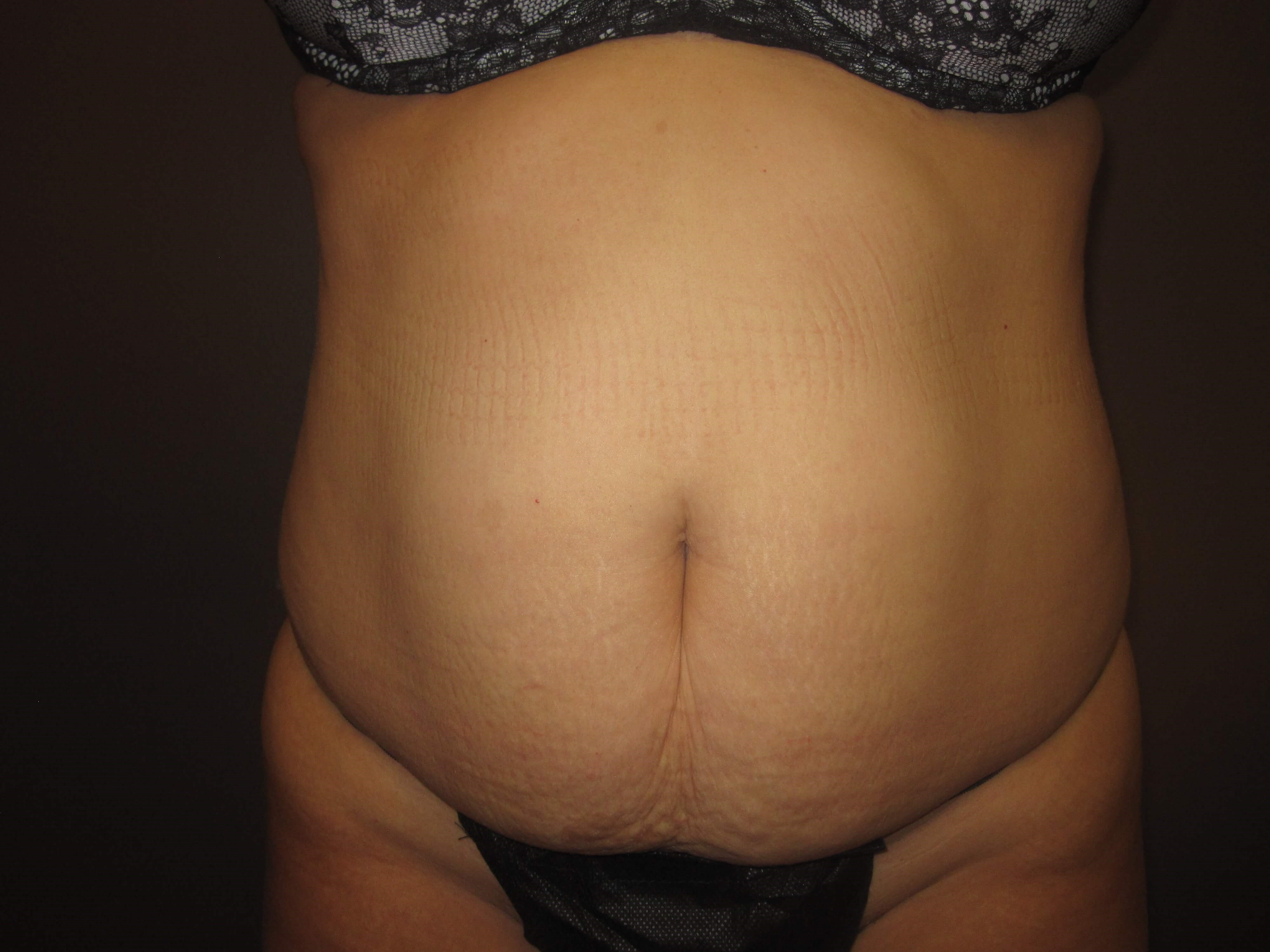 Timeless Tuck Front View Before