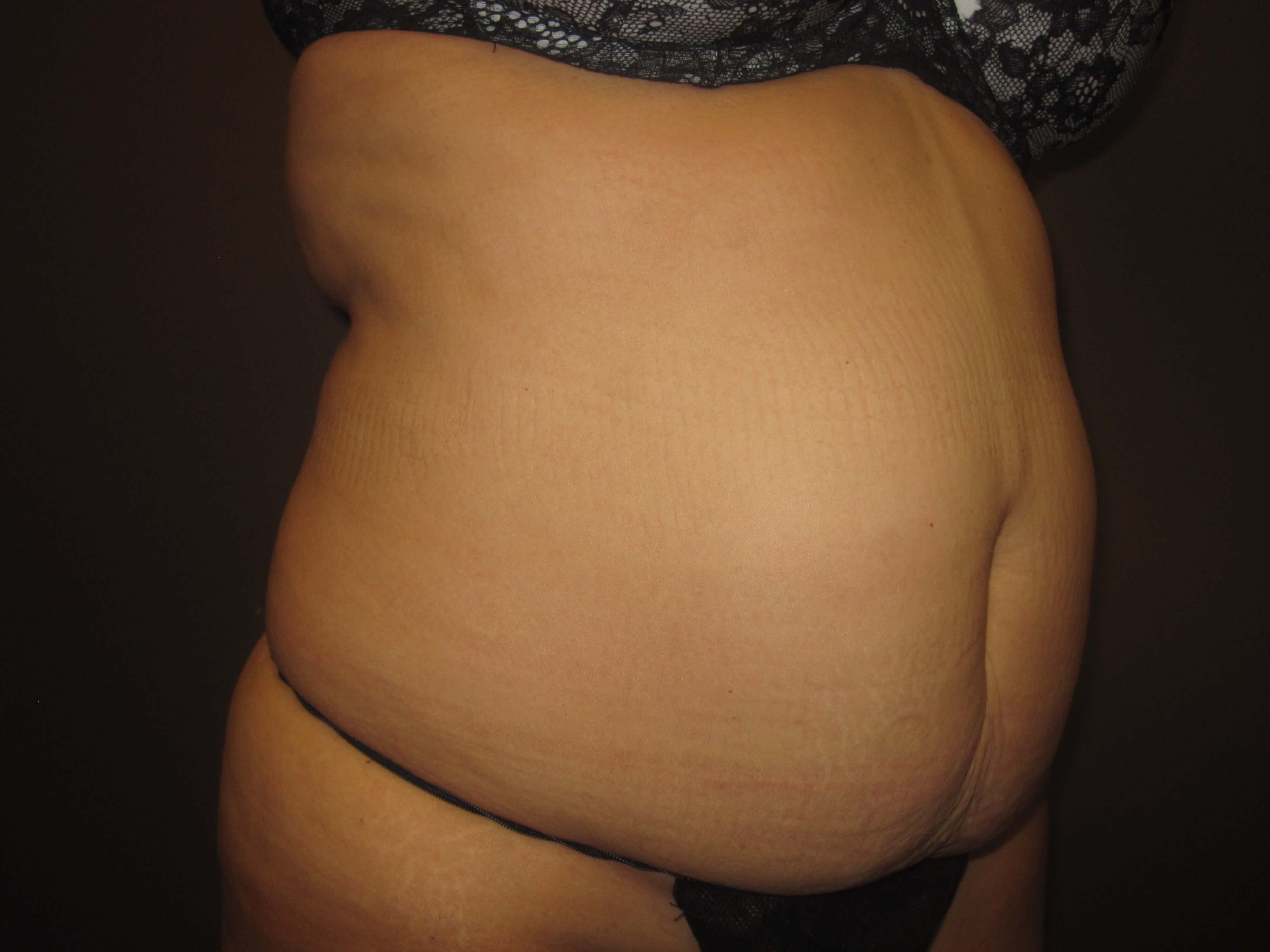 Timeless Tuck Oblique View Before