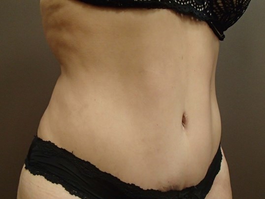 Timeless Tuck Oblique View After