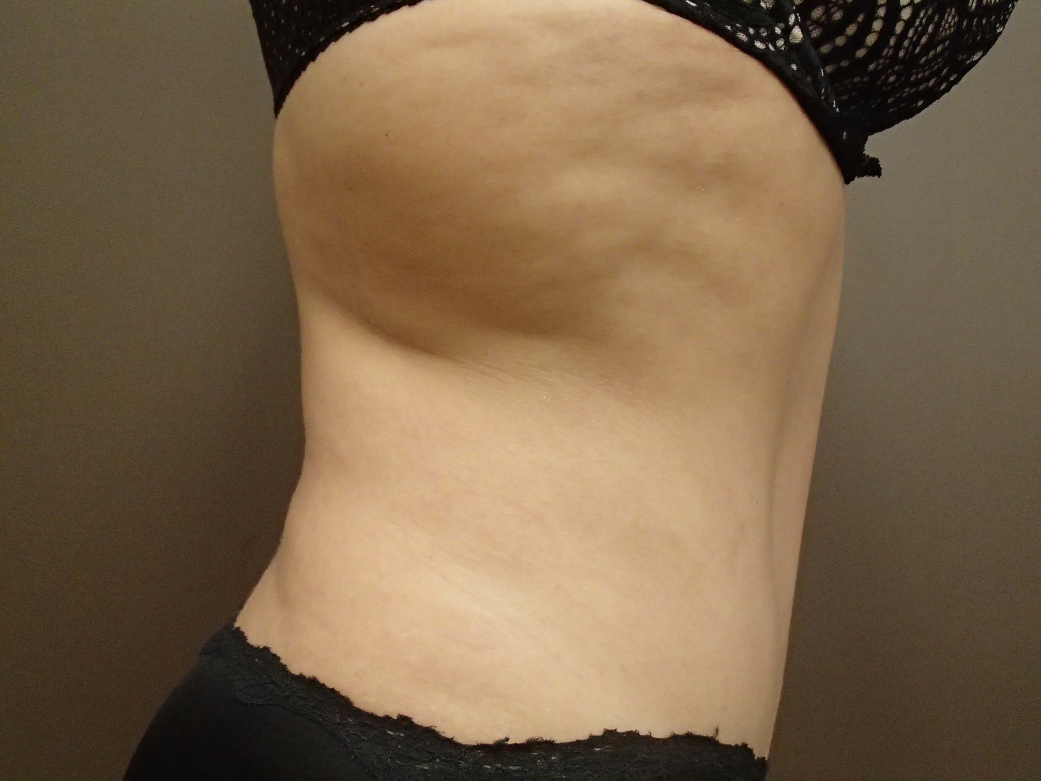 Timeless Tuck Side View After