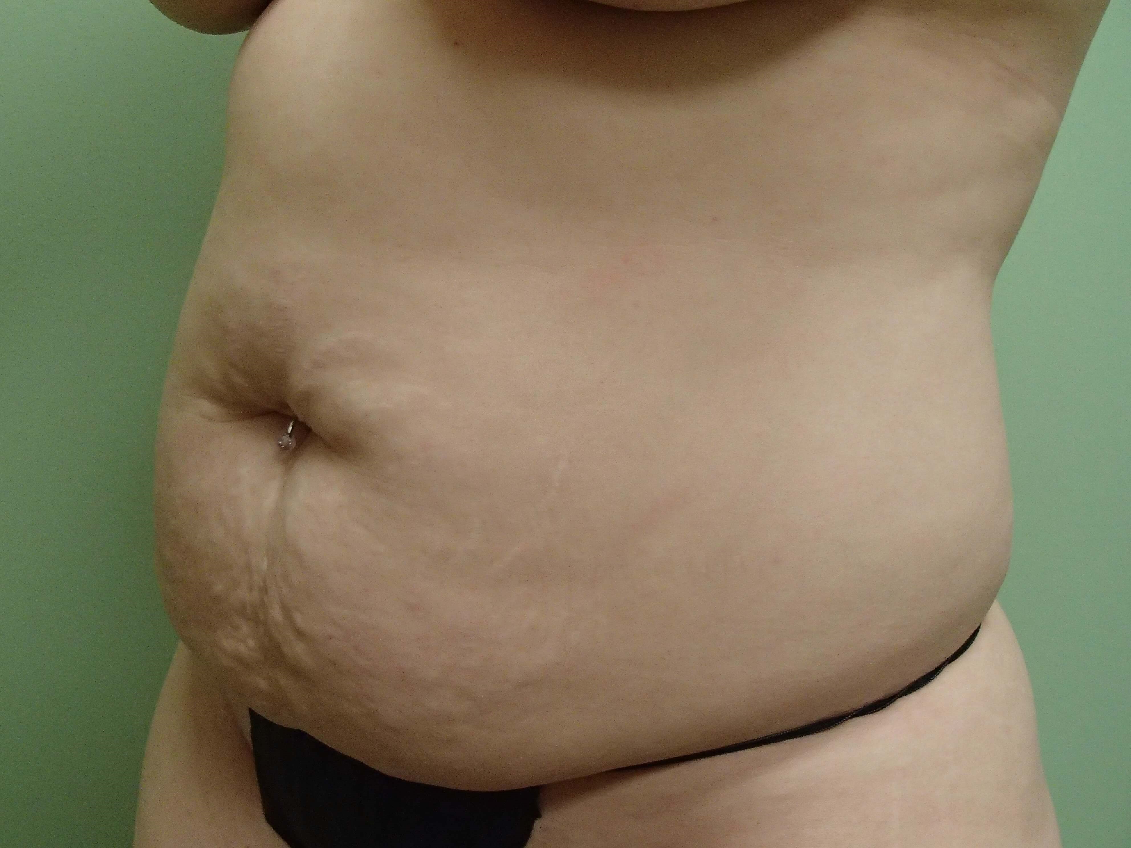 Timeless Tuck Oblique View Before