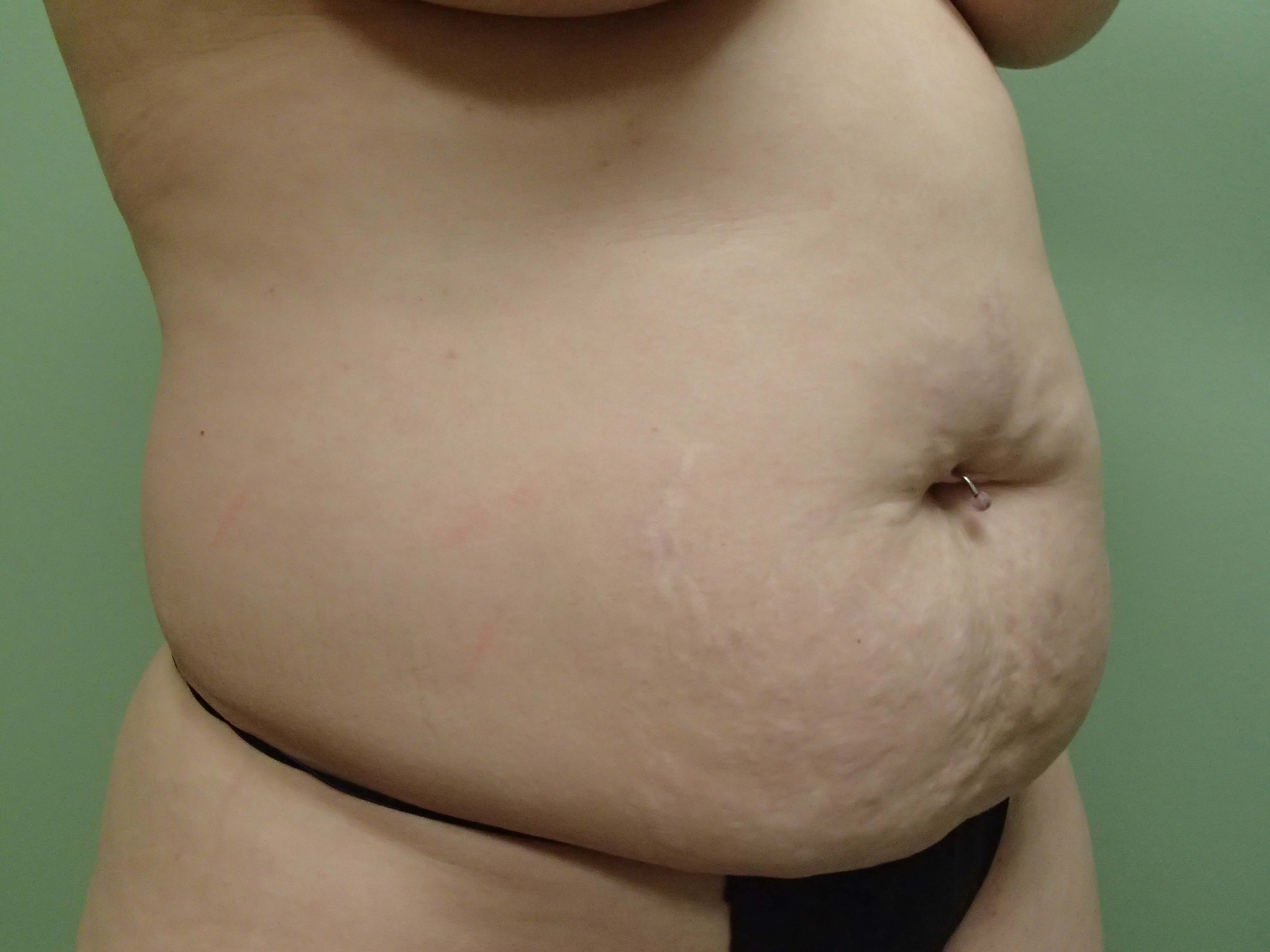Timeless Tuck Oblique View Before