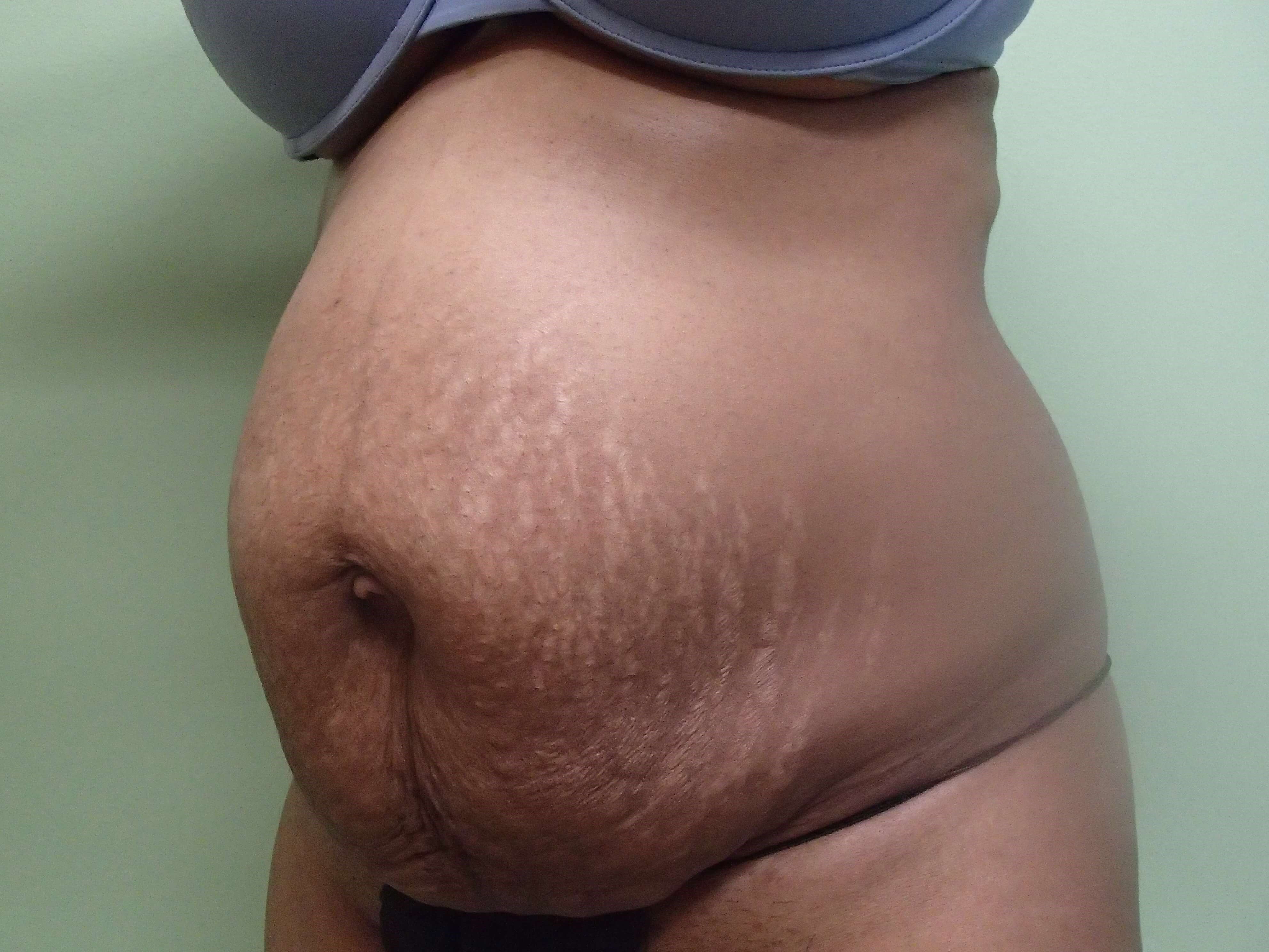 Timeless Tuck Oblique View Before