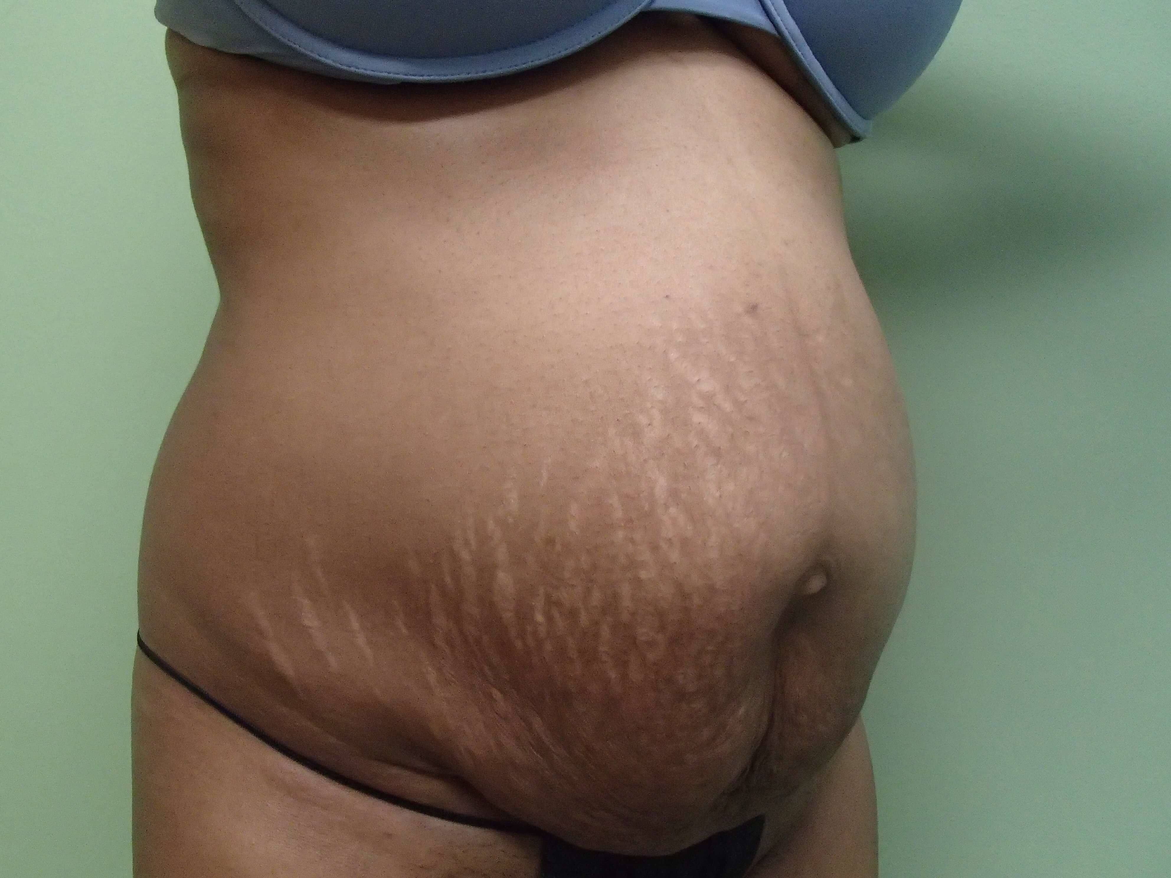 Timeless Tuck Oblique View Before
