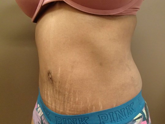 Timeless Tuck Oblique View After