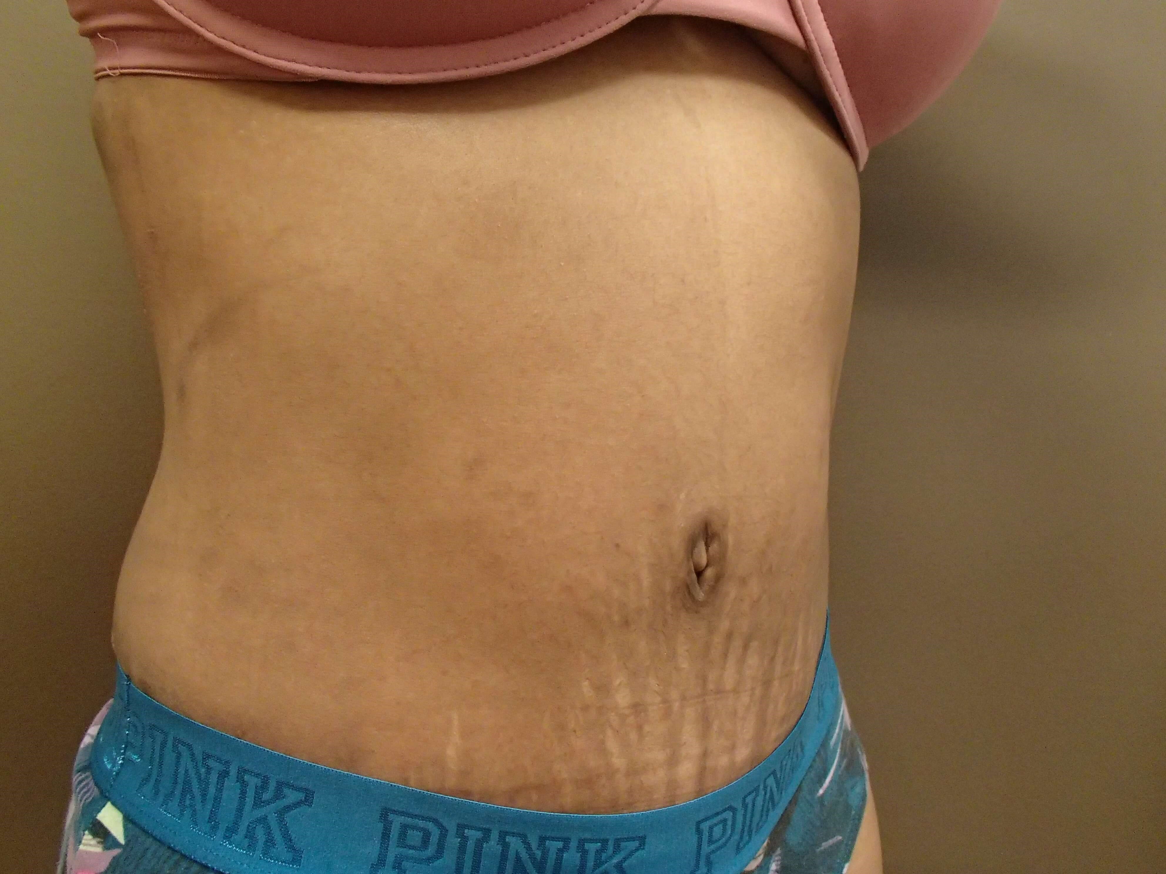 Timeless Tuck Oblique View After