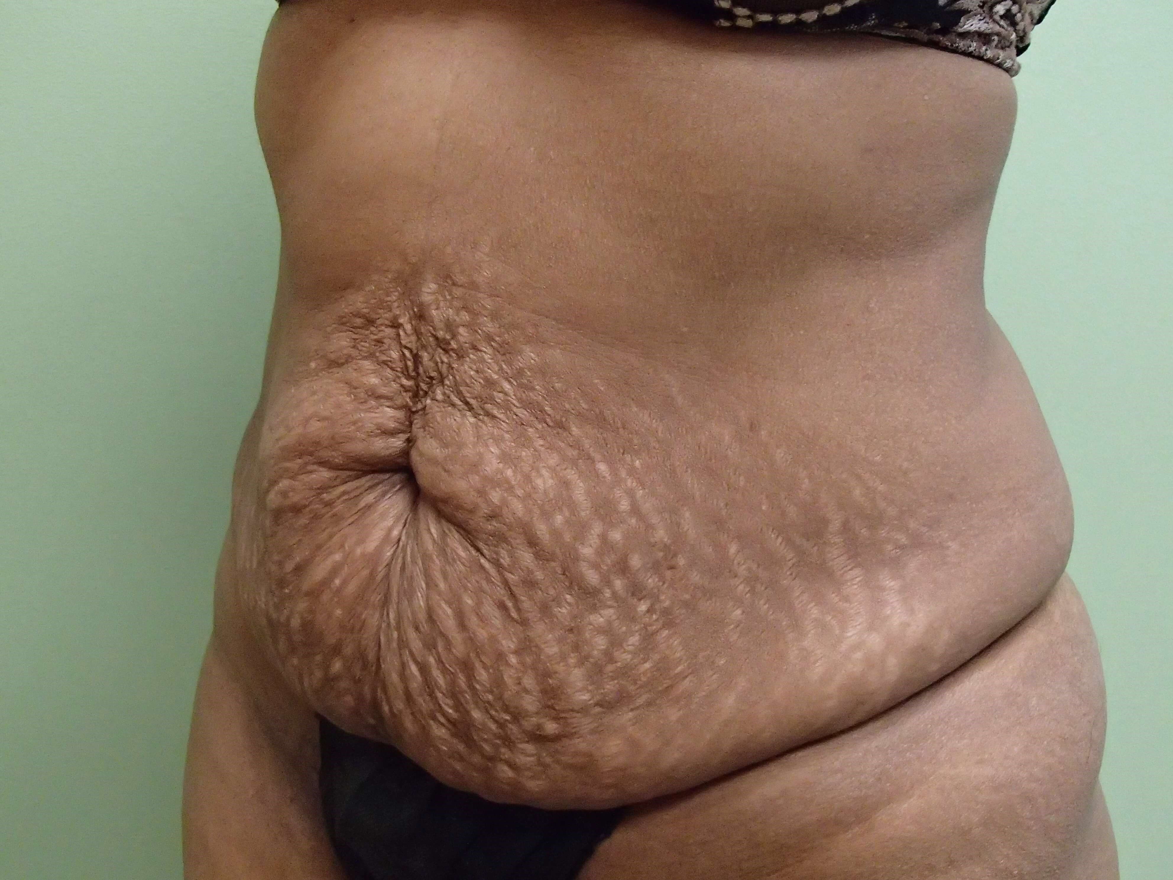 Timeless Tuck Oblique View Before