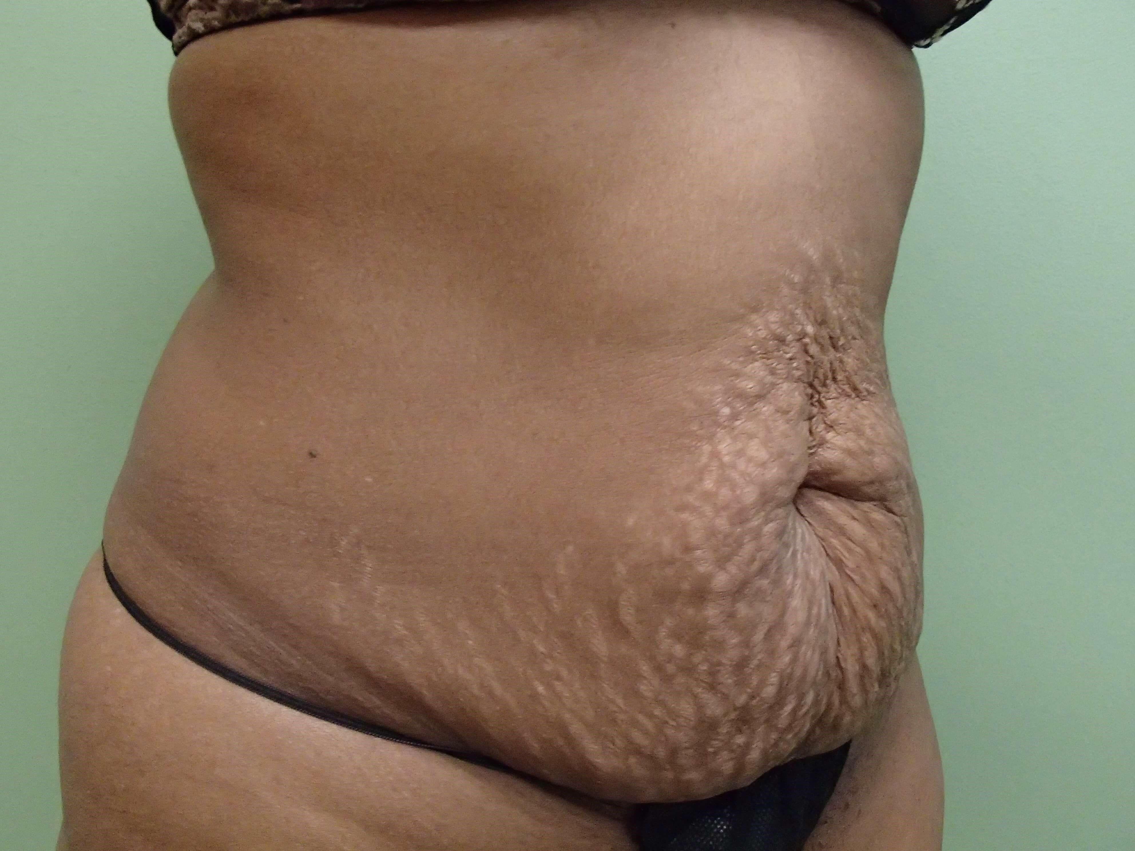 Timeless Tuck Oblique View Before