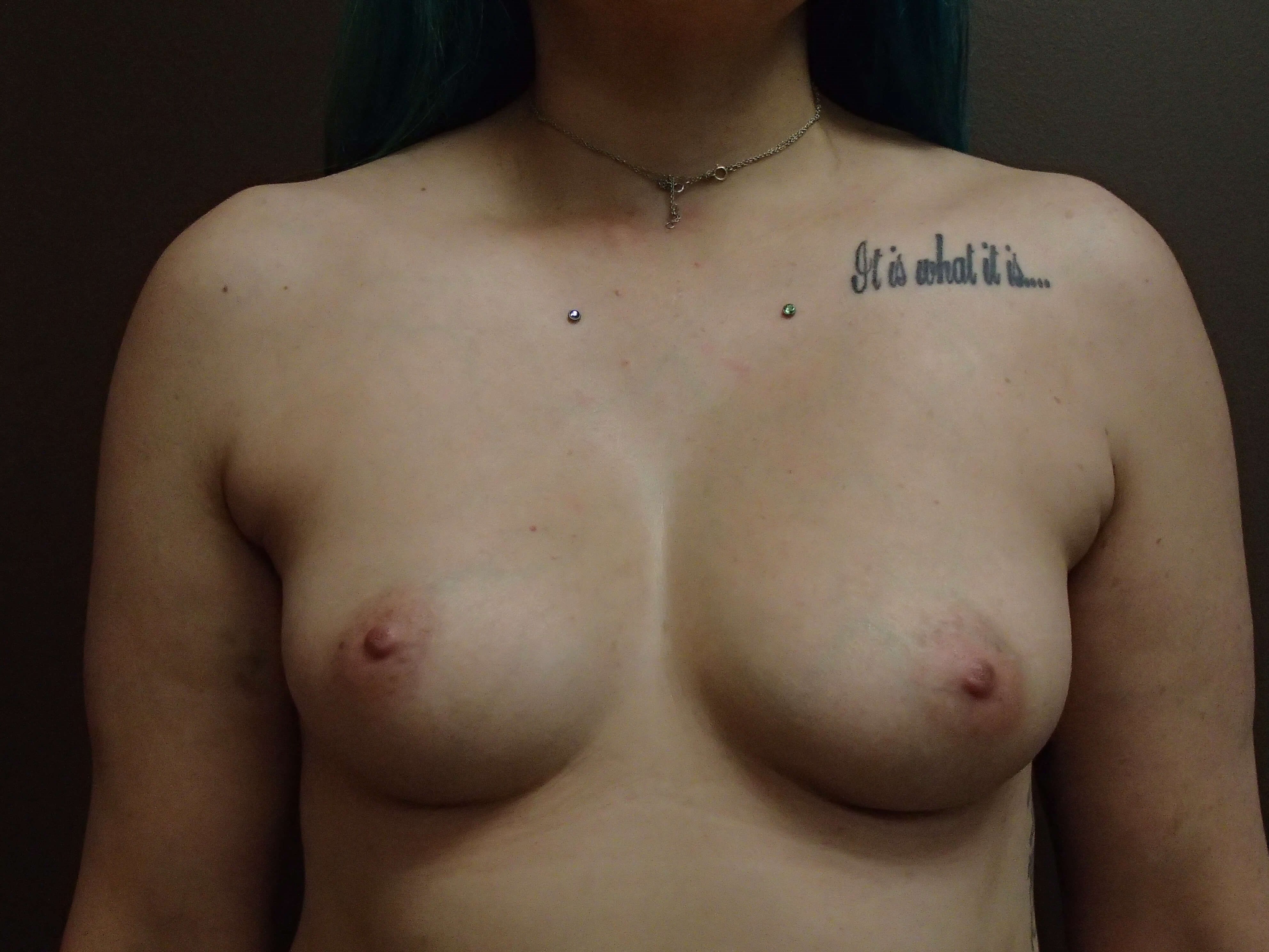 Breast Augmentation Front Before