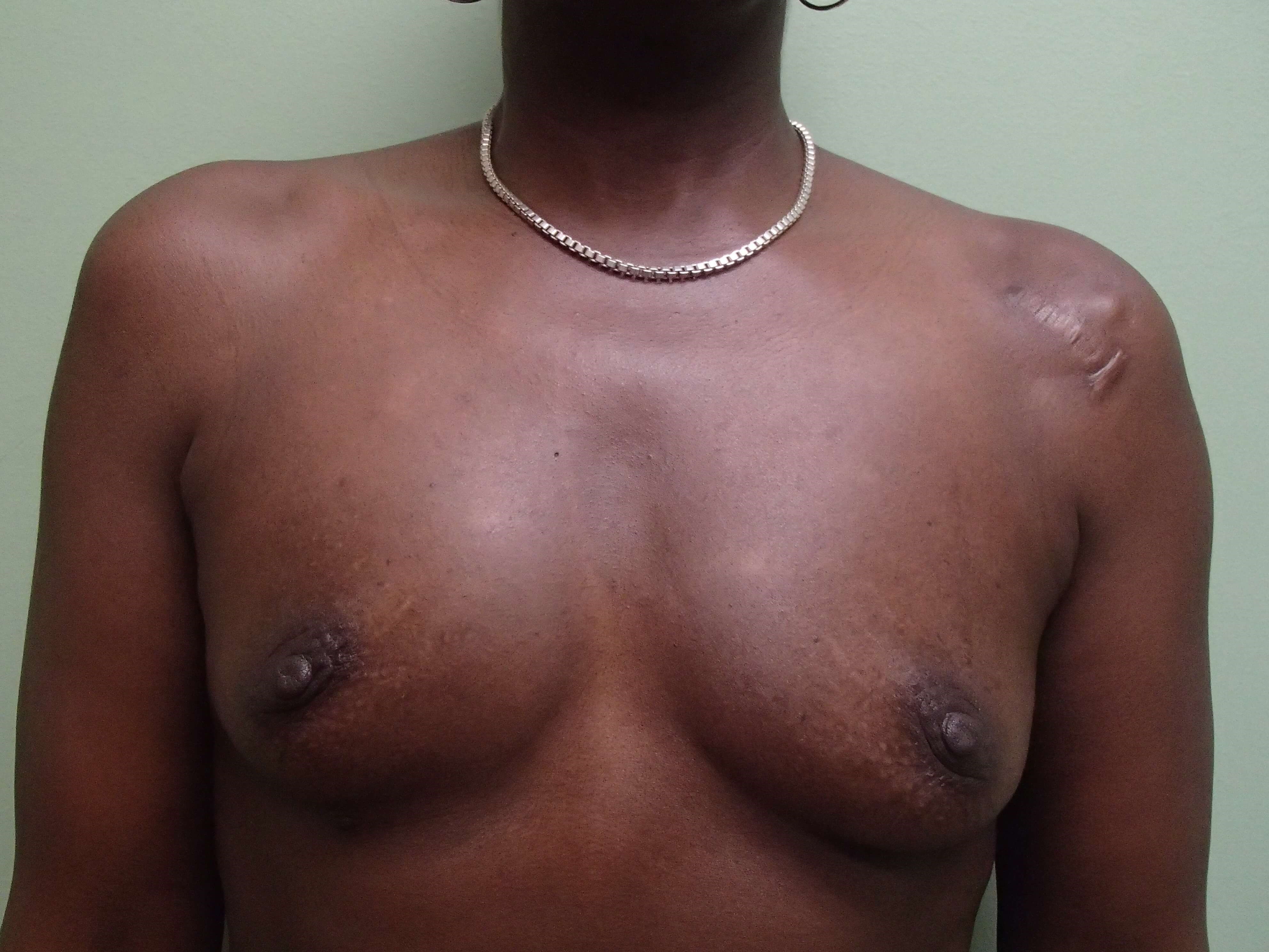Breast Augmentation Front Before