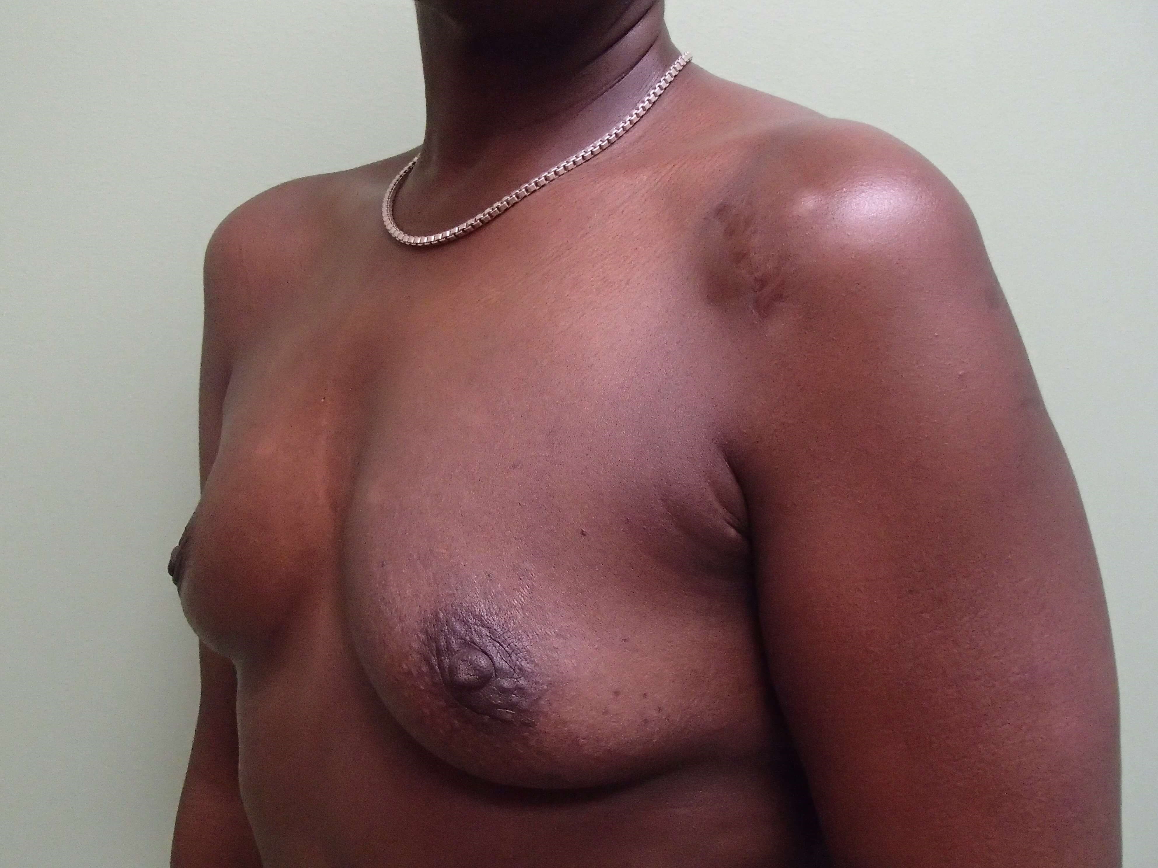 Breast Aug Oblique View Before
