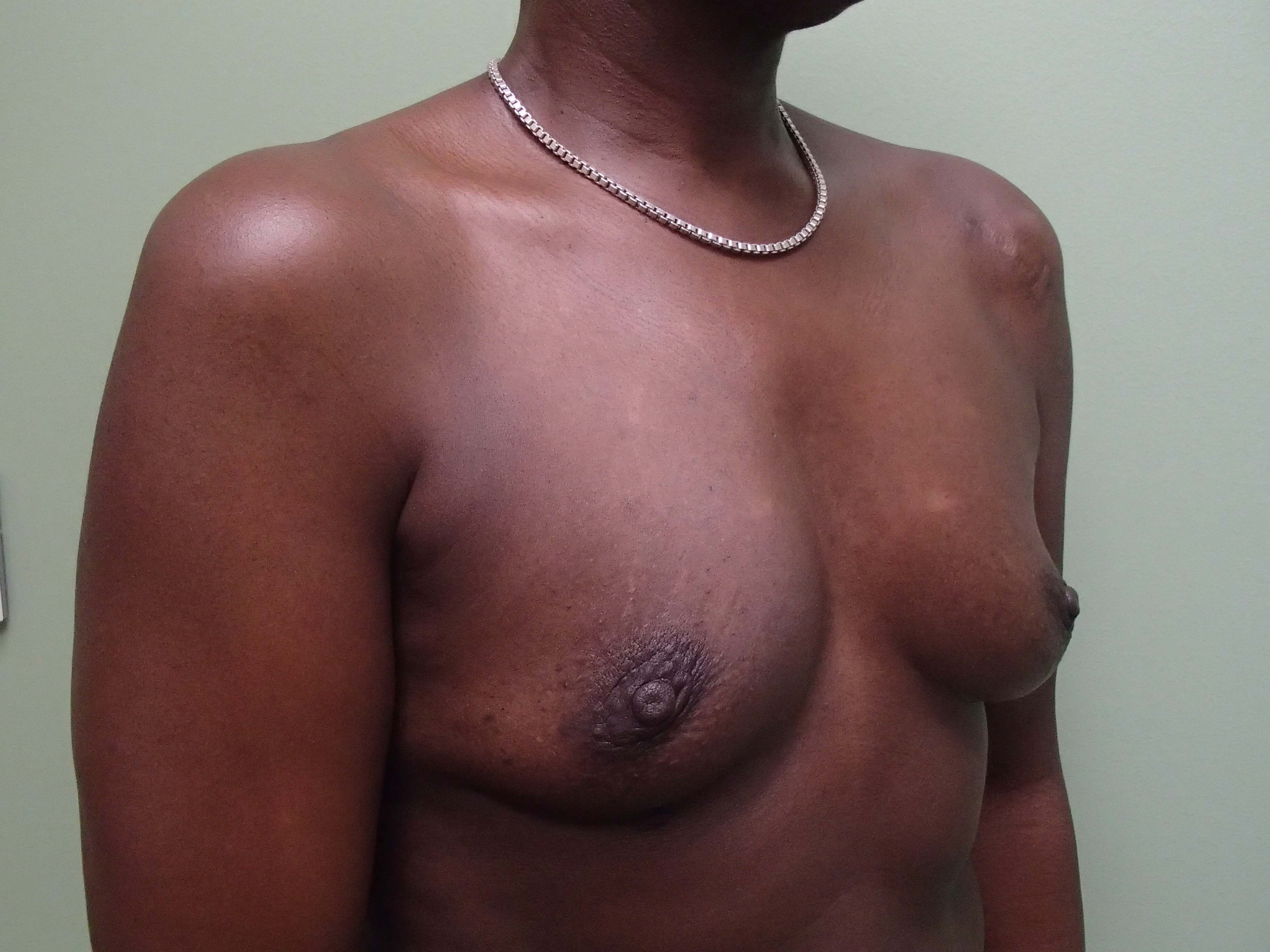 Breast Aug Oblique View Before