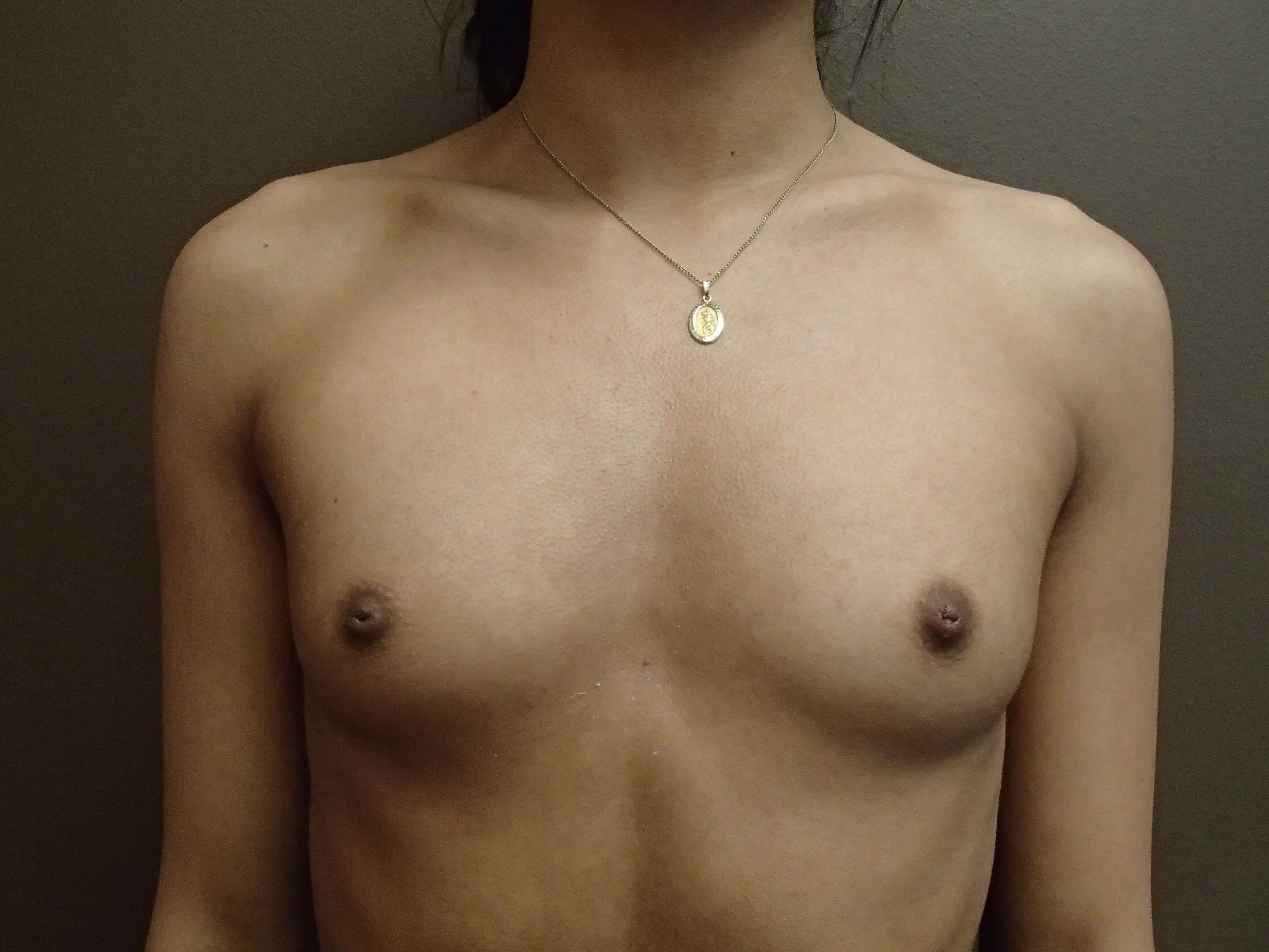 Breast Augmentation Front Before