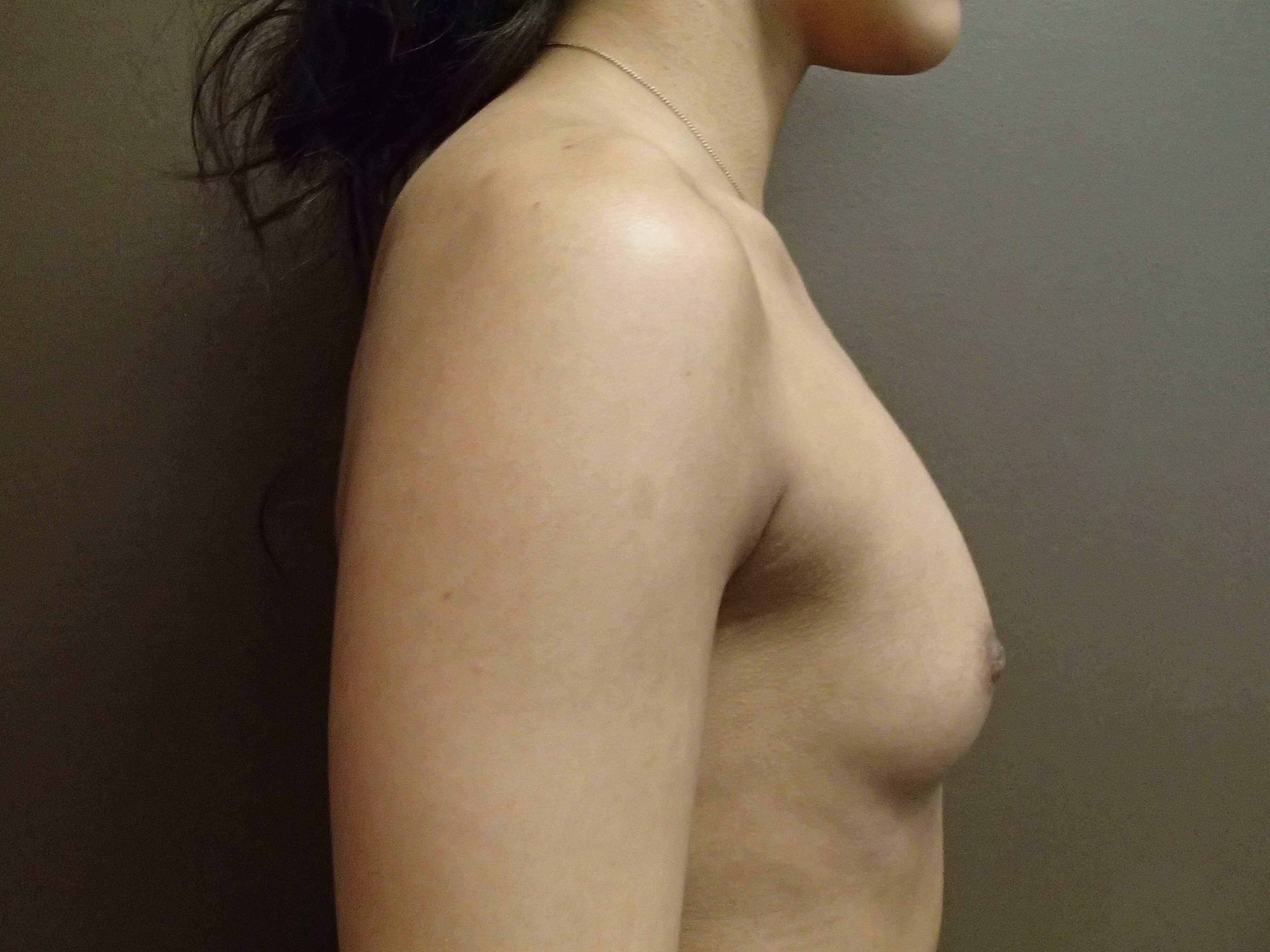 Breast Aug Side View Before