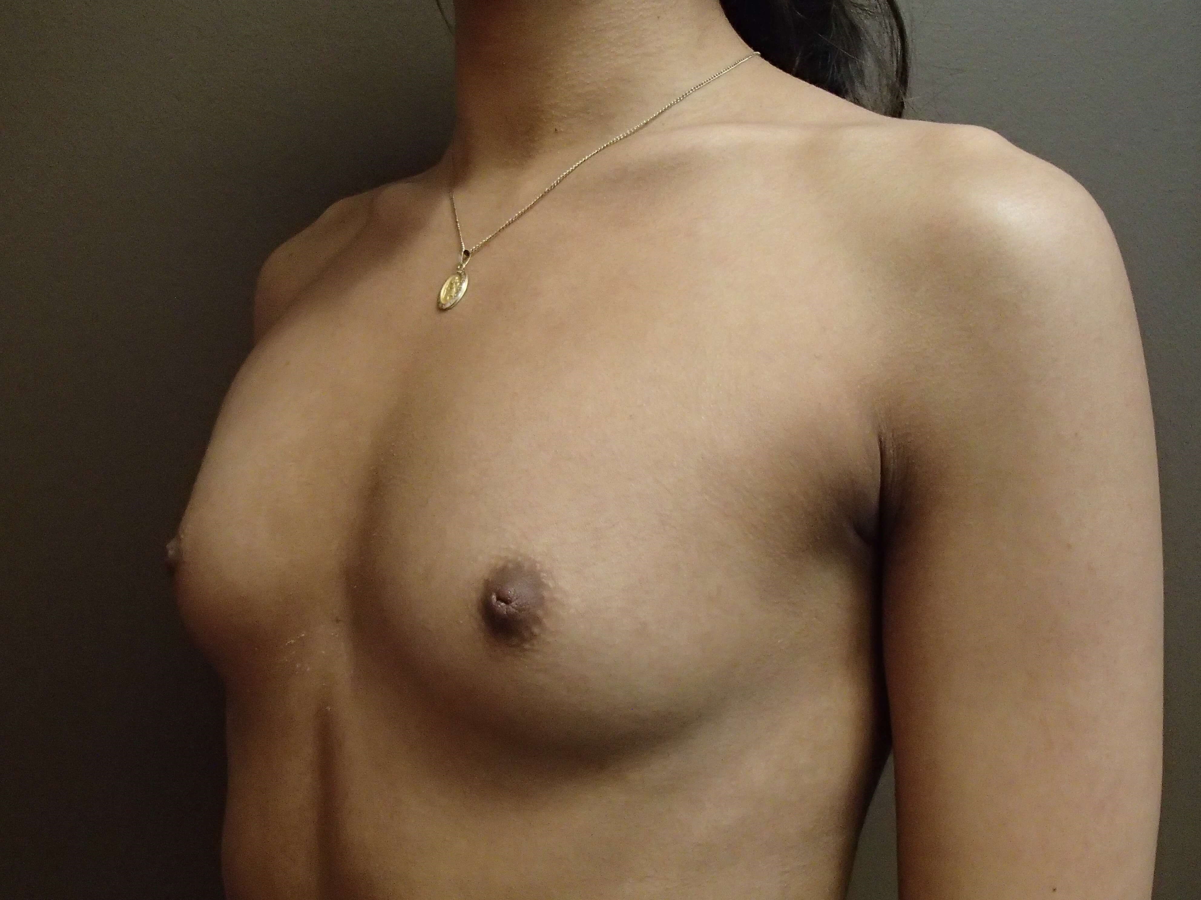 Breast Aug Oblique View Before