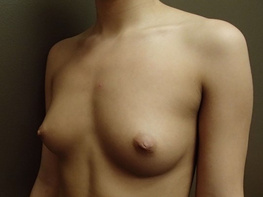 Breast Augmentation Oblique Before