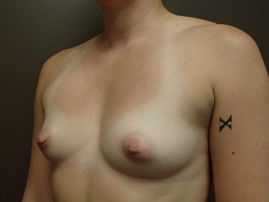 Breast Augmentation Oblique Before