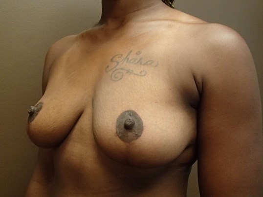 Mastopexy (Breast Lift) Before