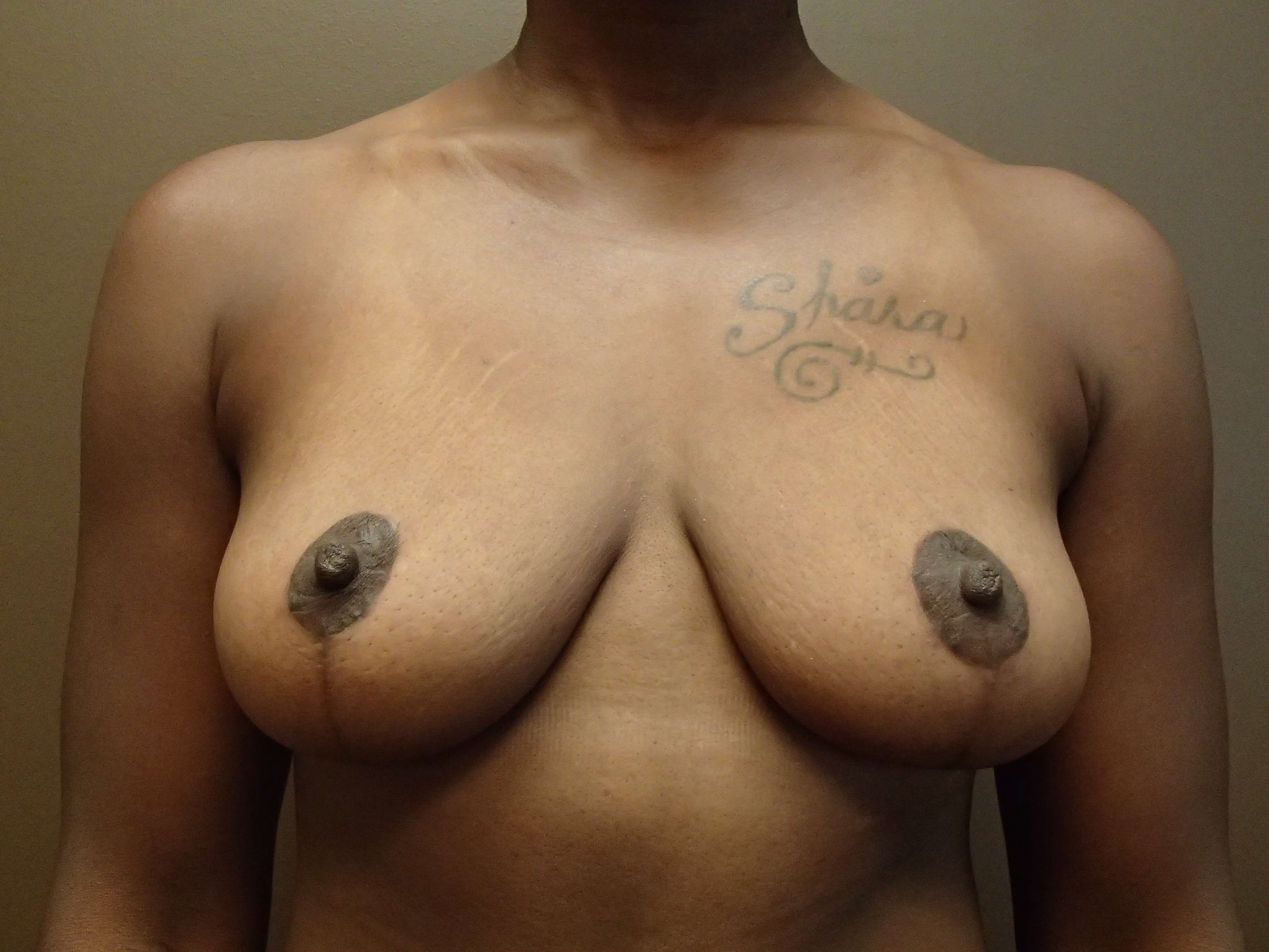 Mastopexy (Breast Lift) Front After