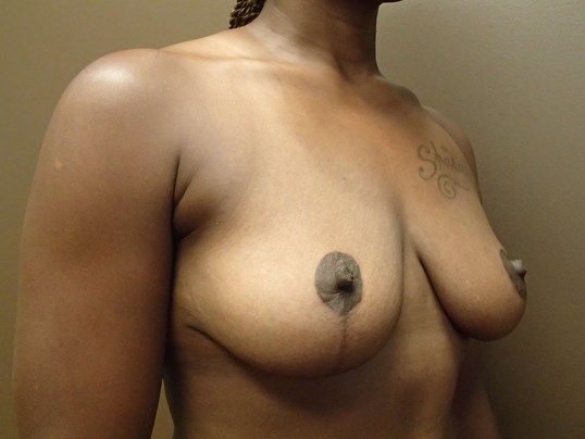 Mastopexy (Breast Lift) After