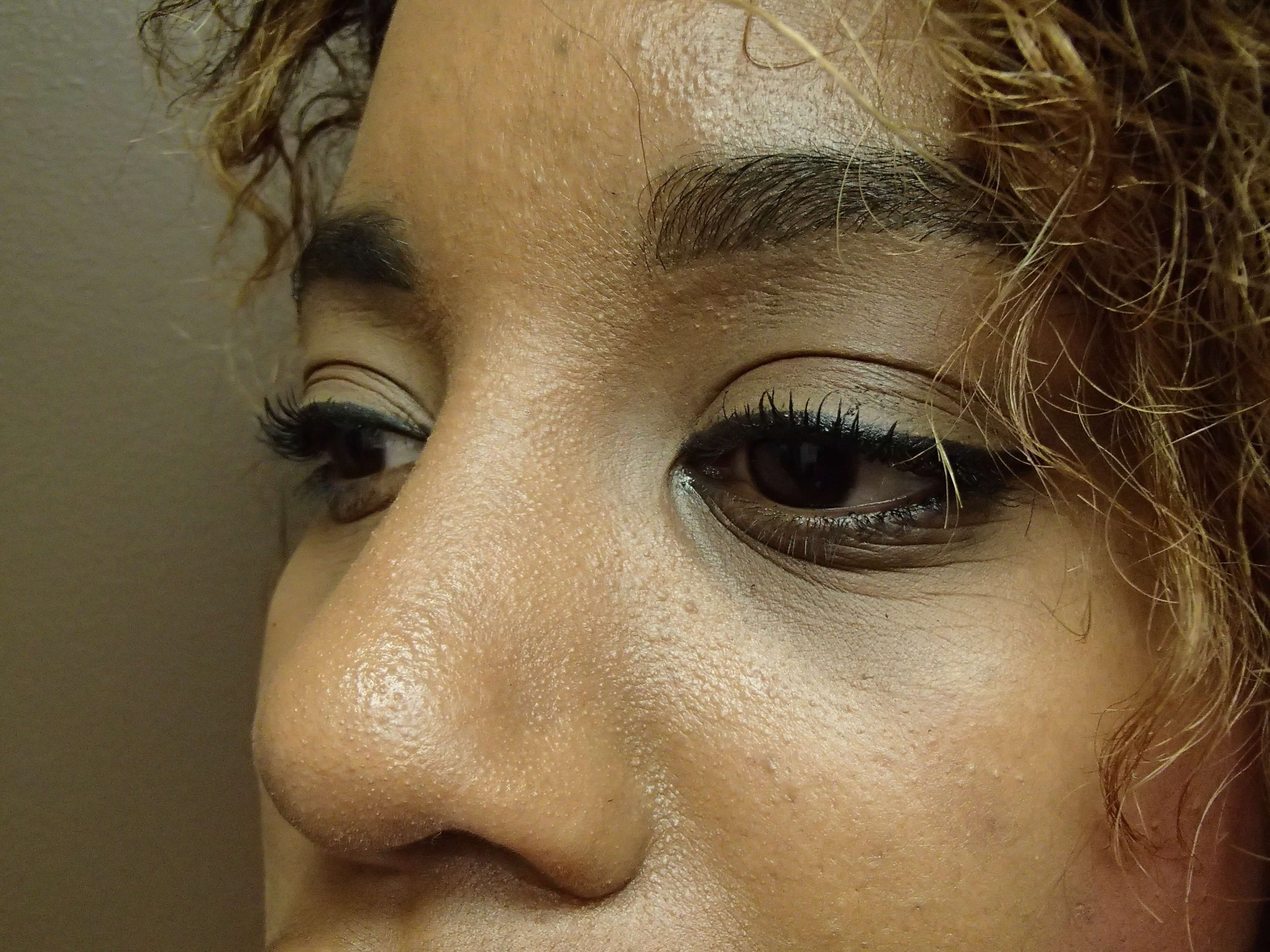Rhinoplasty with Implant After