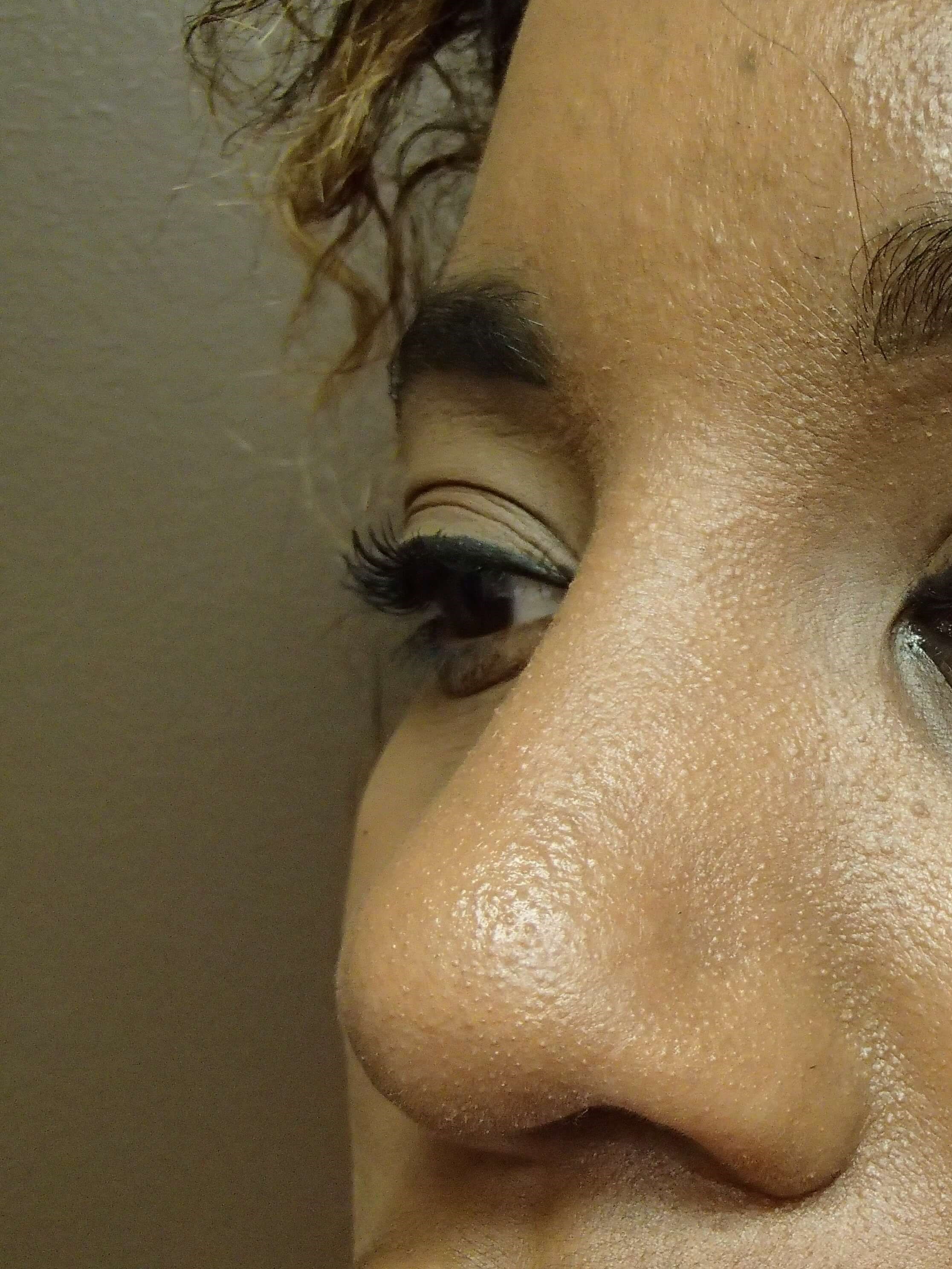 Rhinoplasty with Implant After
