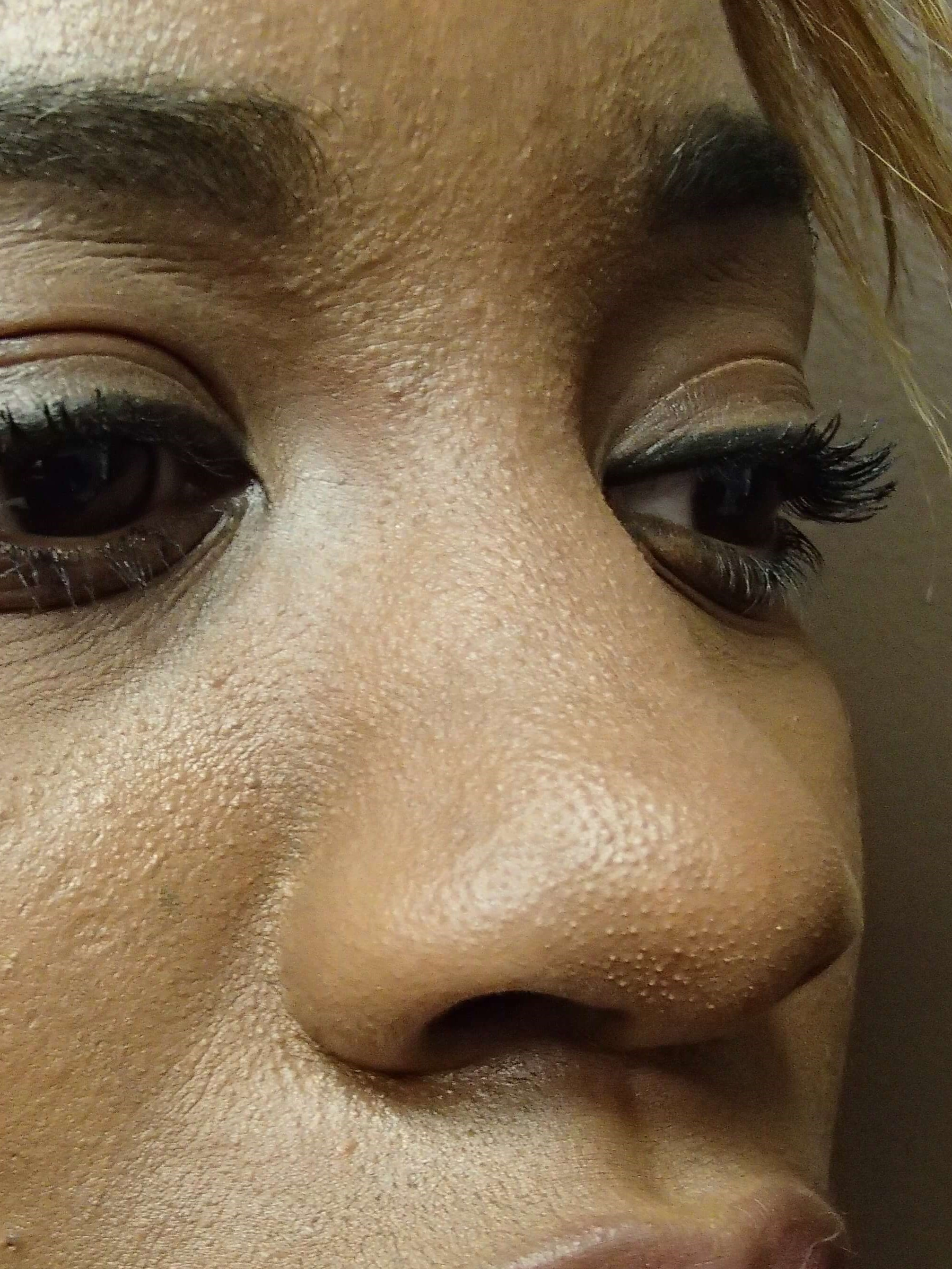 Rhinoplasty with Implant Before