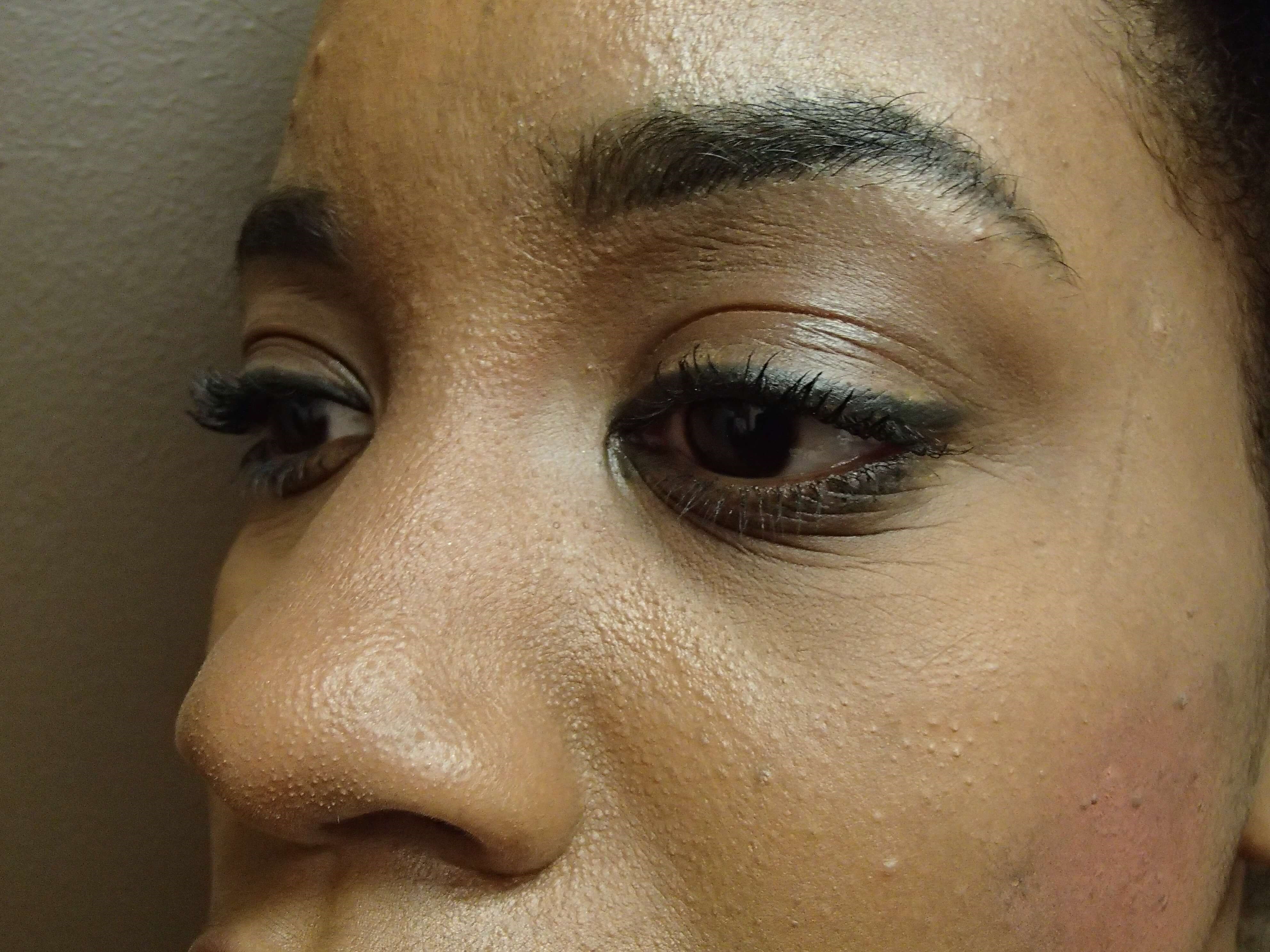 Rhinoplasty with Implant Before