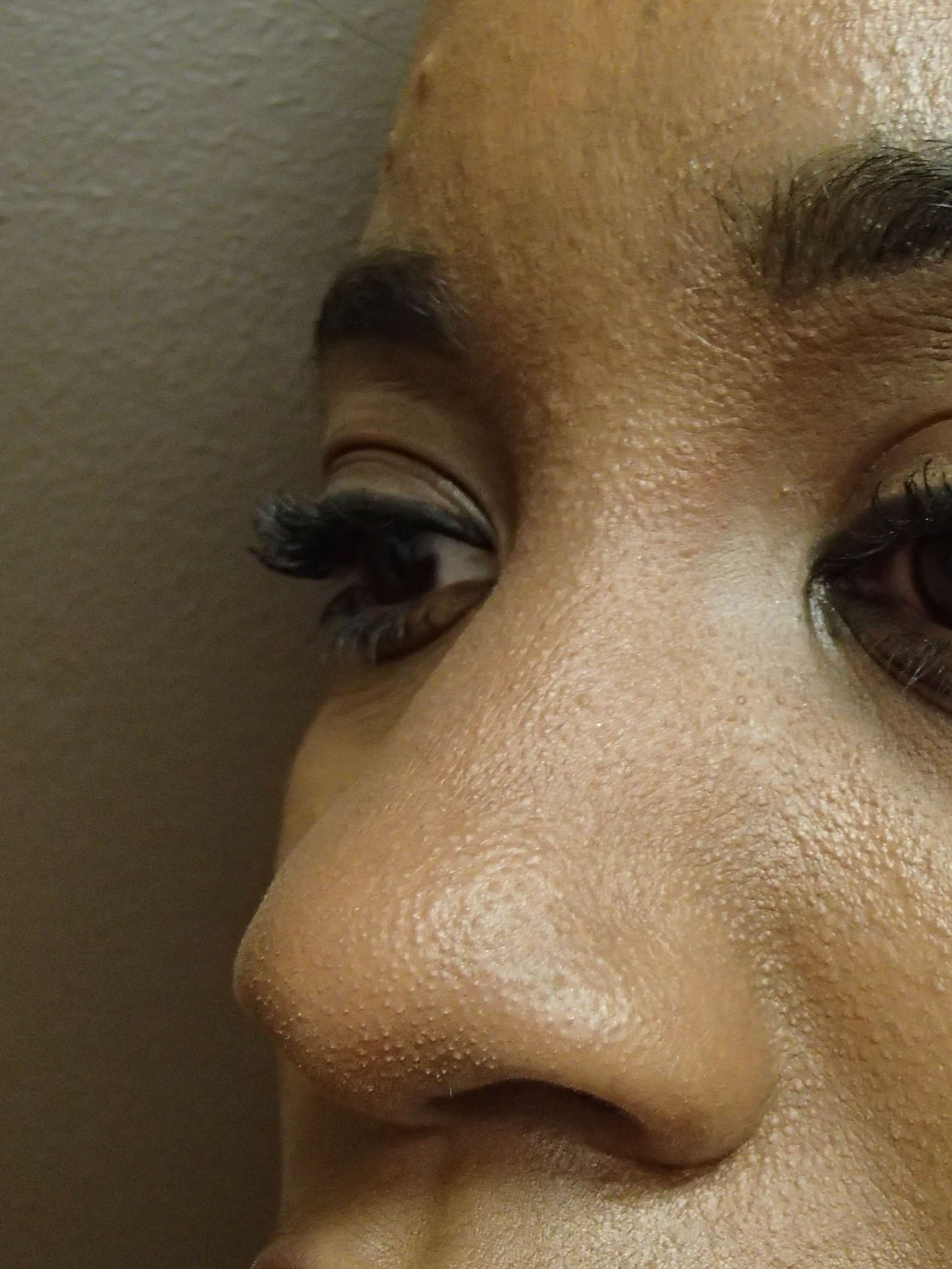 Rhinoplasty with Implant Before