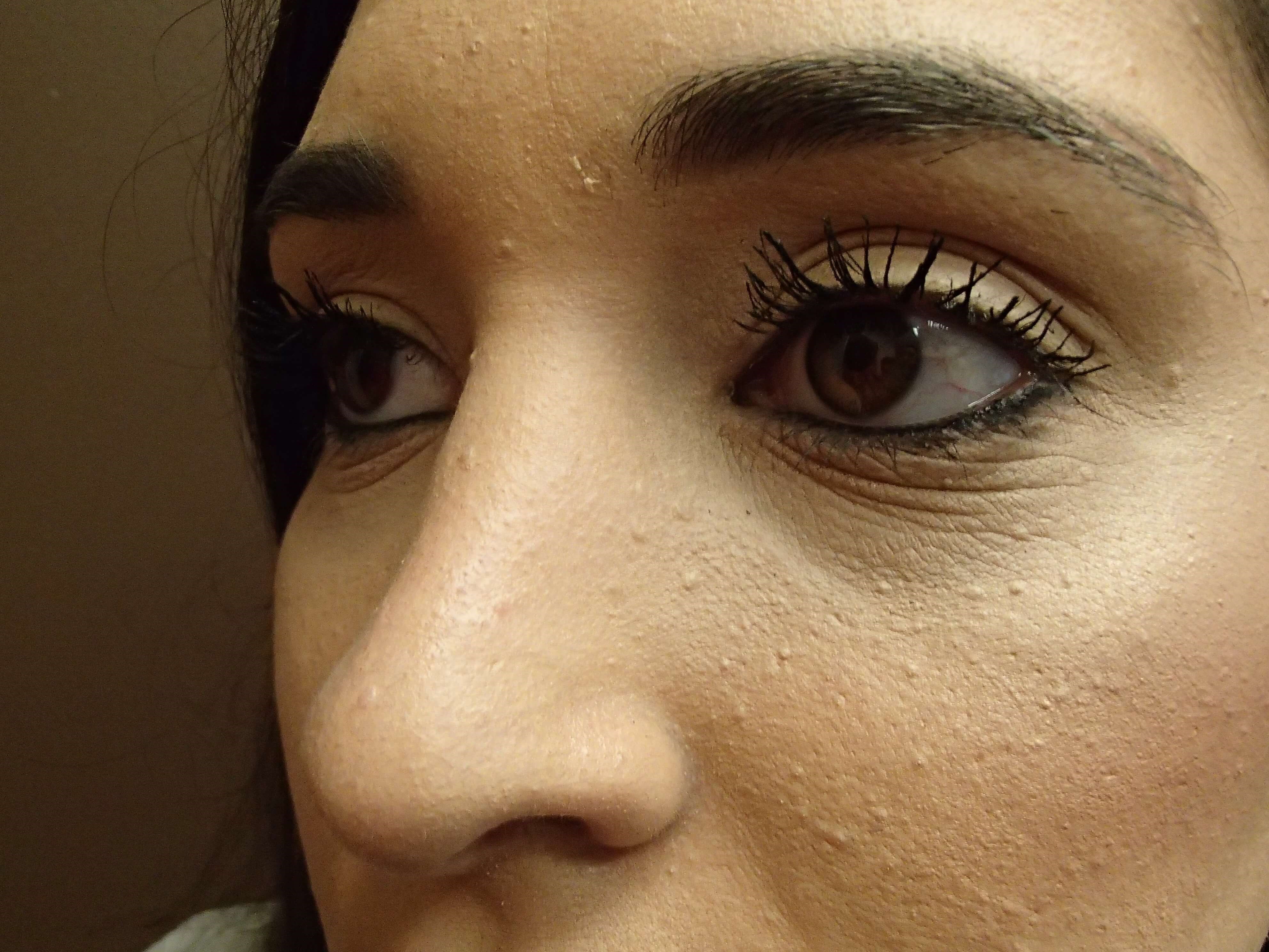 Rhinoplasty (nose job) After