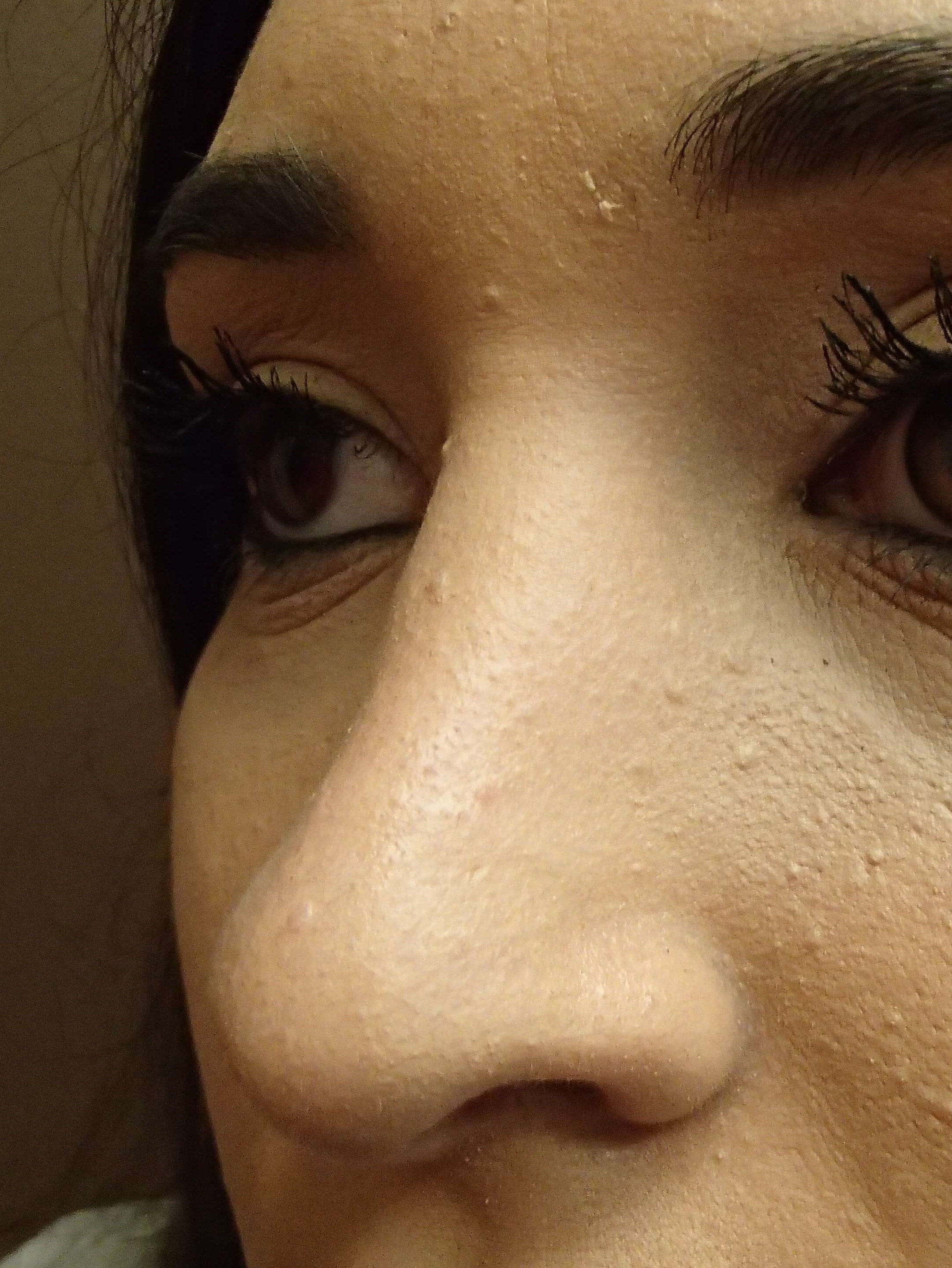 Rhinoplasty (nose job) After