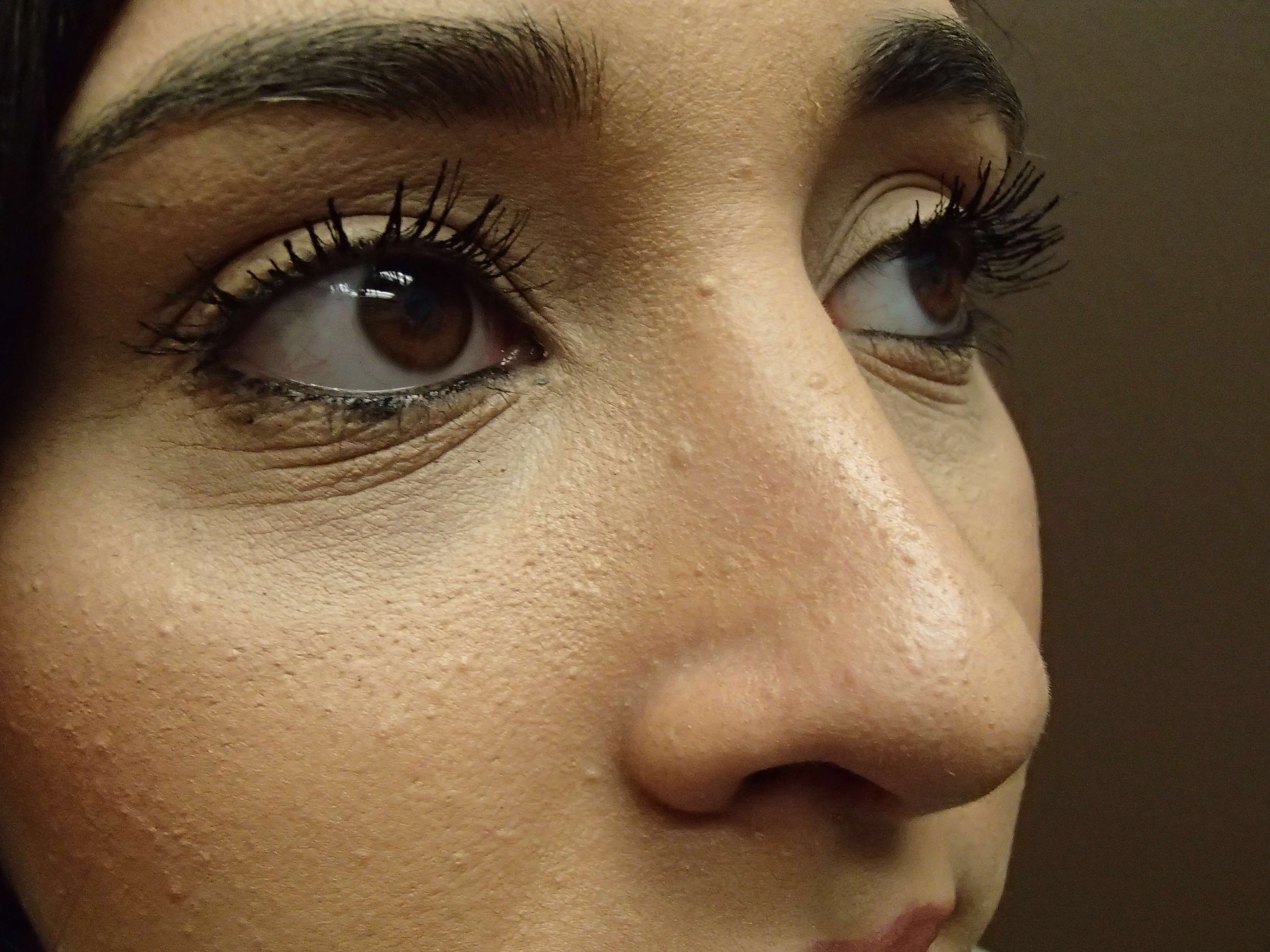 Rhinoplasty (nose job) After