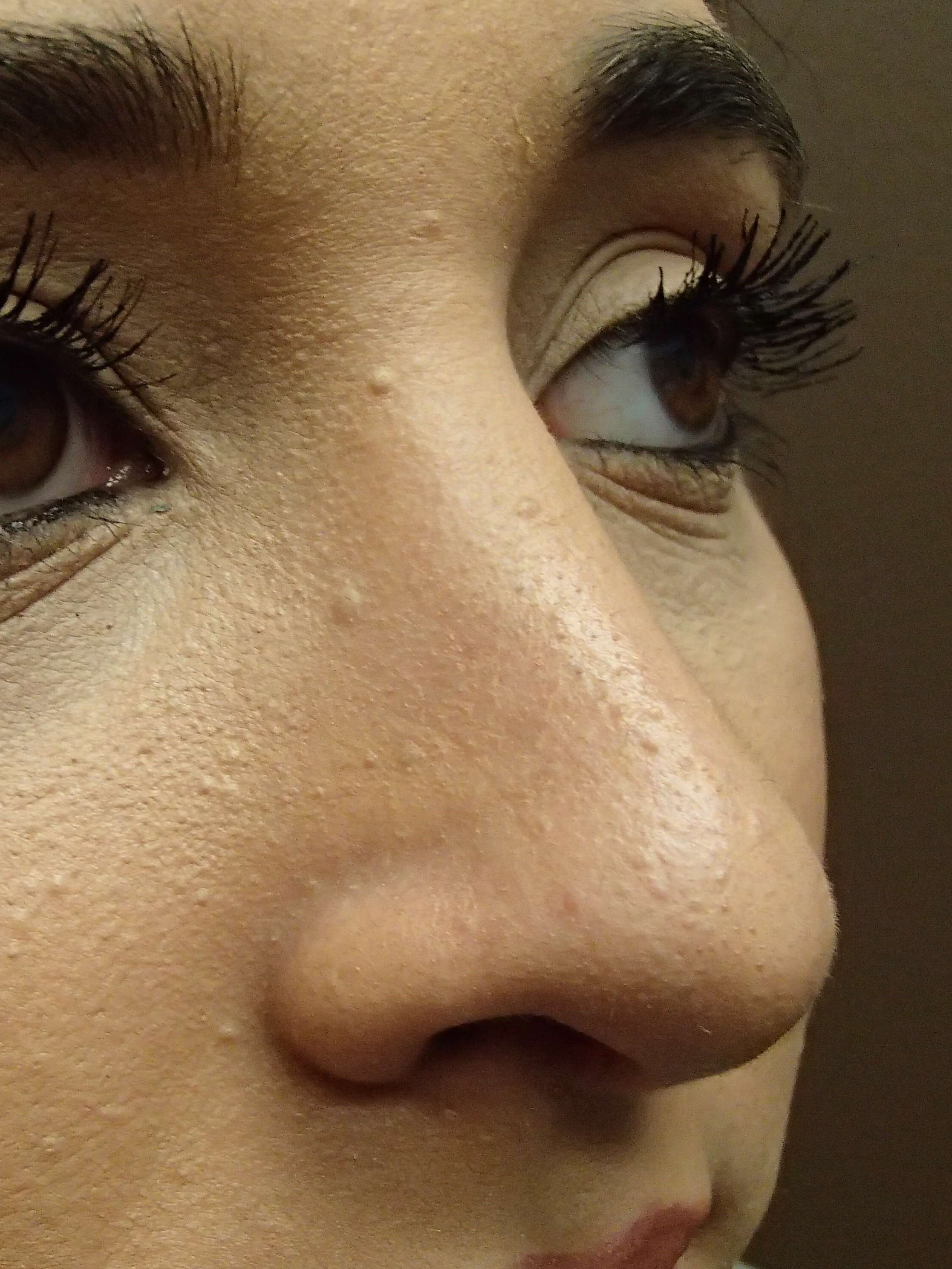 Rhinoplasty (nose job) After