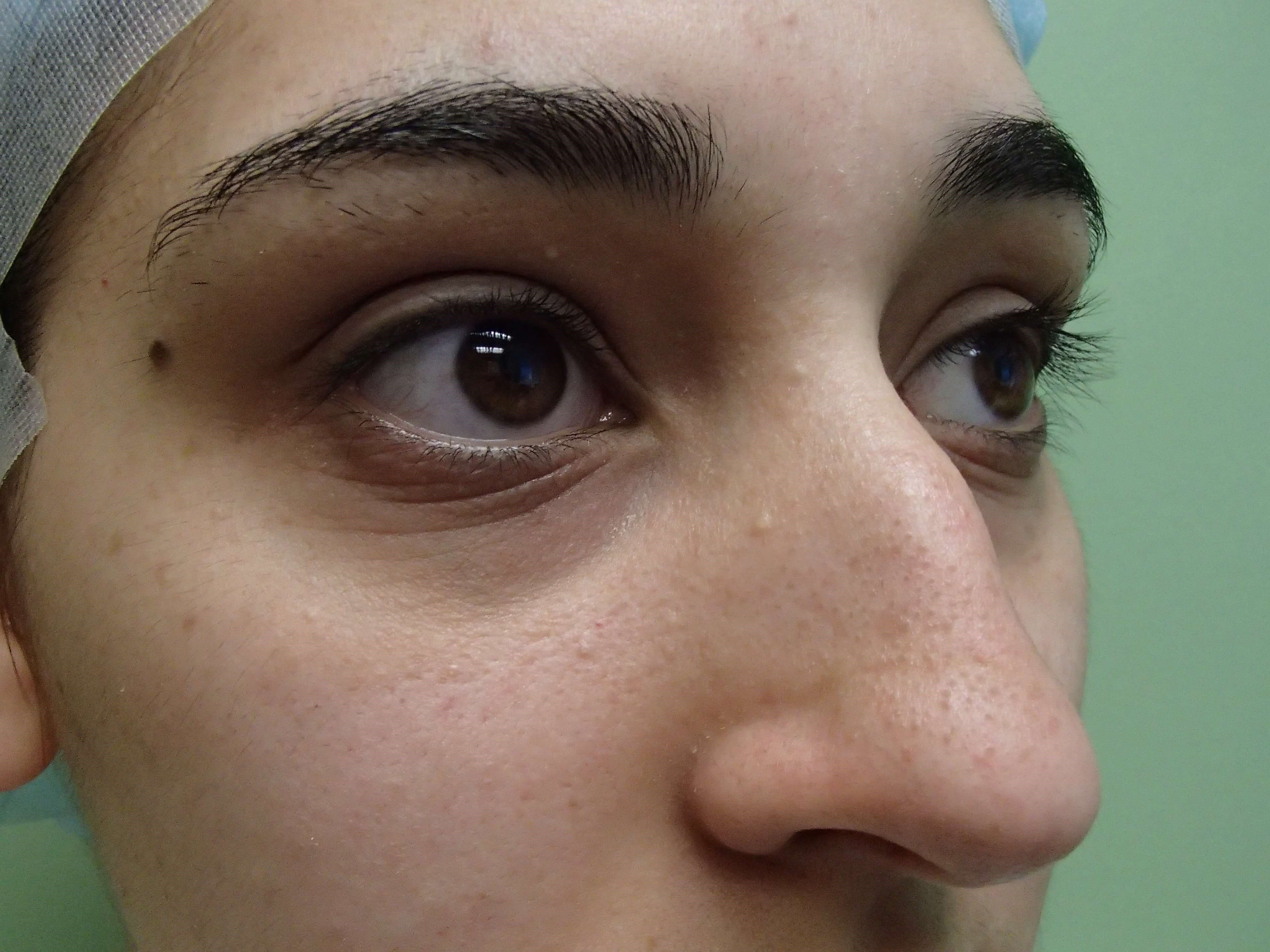Rhinoplasty (nose job) Before
