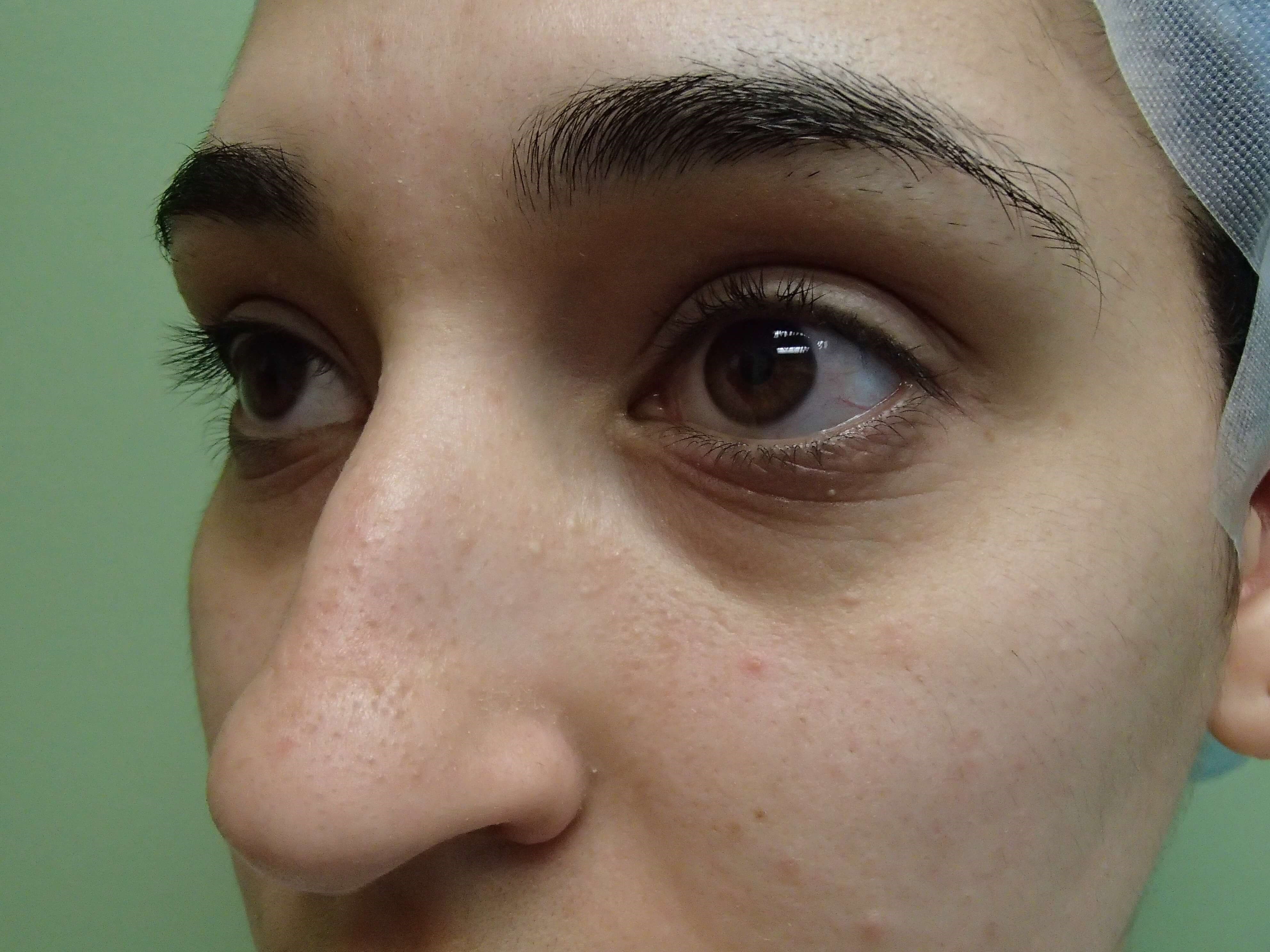 Rhinoplasty (nose job) Before
