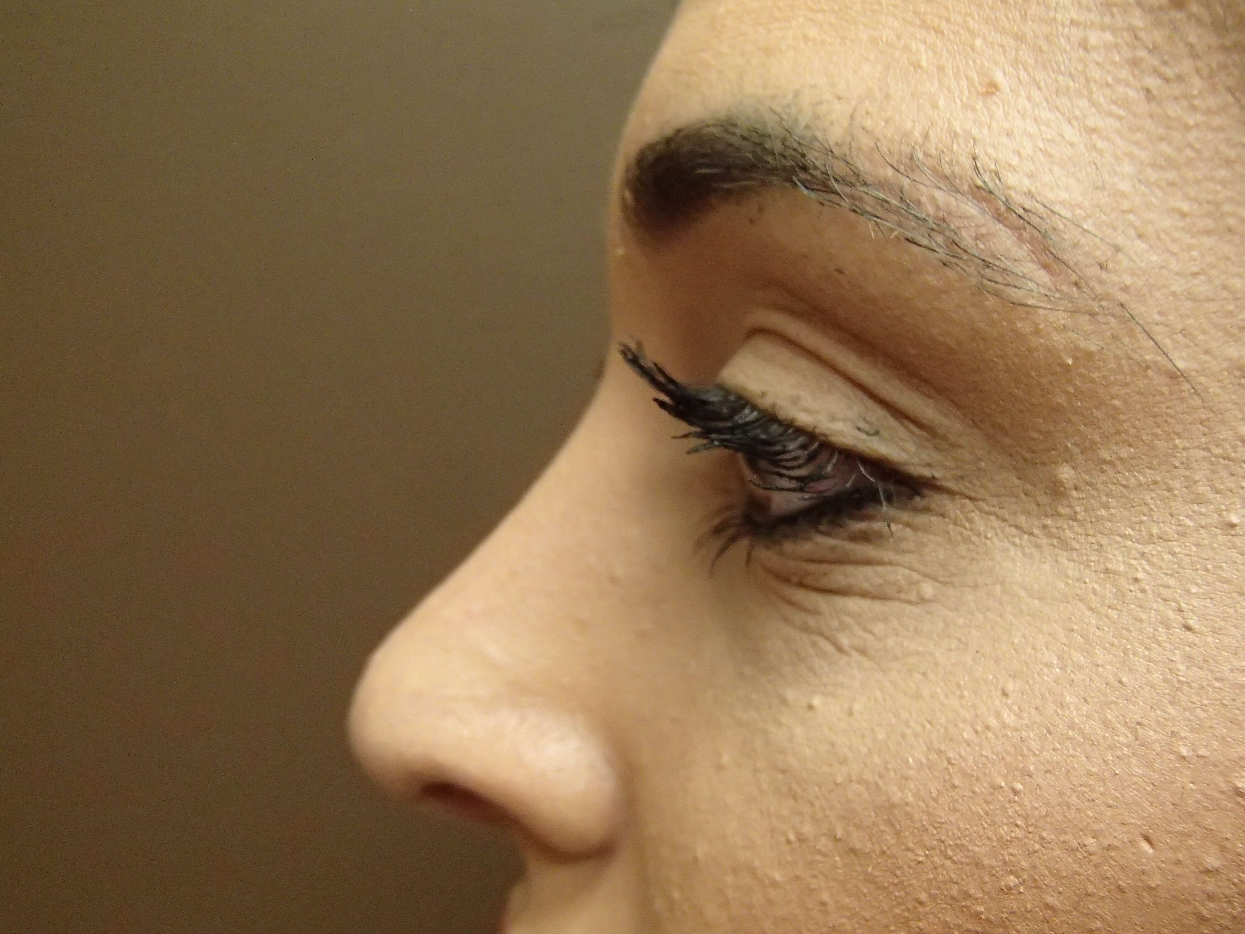 Rhinoplasty (nose job) After