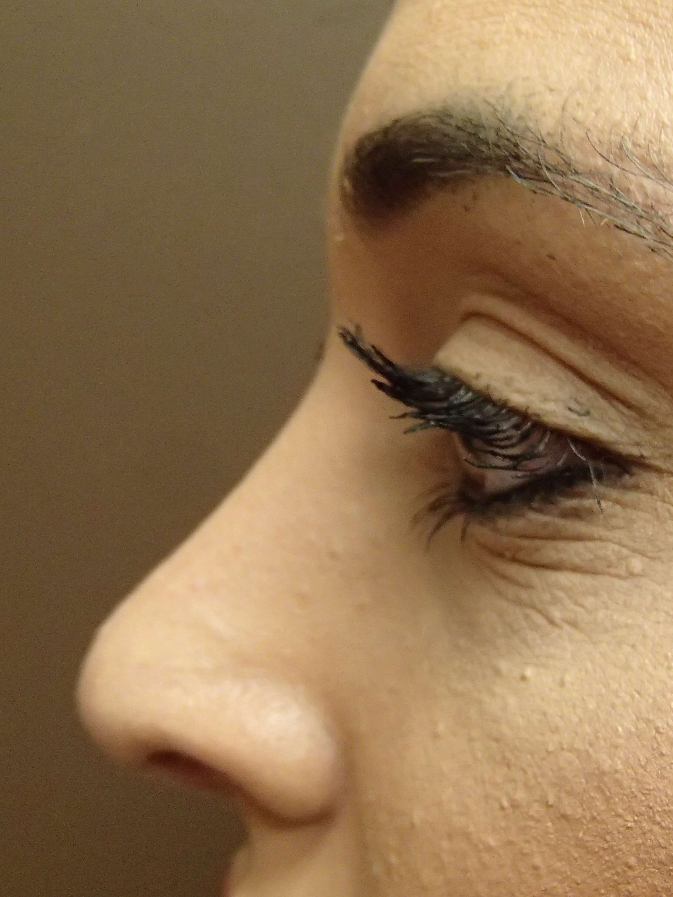 Rhinoplasty (nose job) After