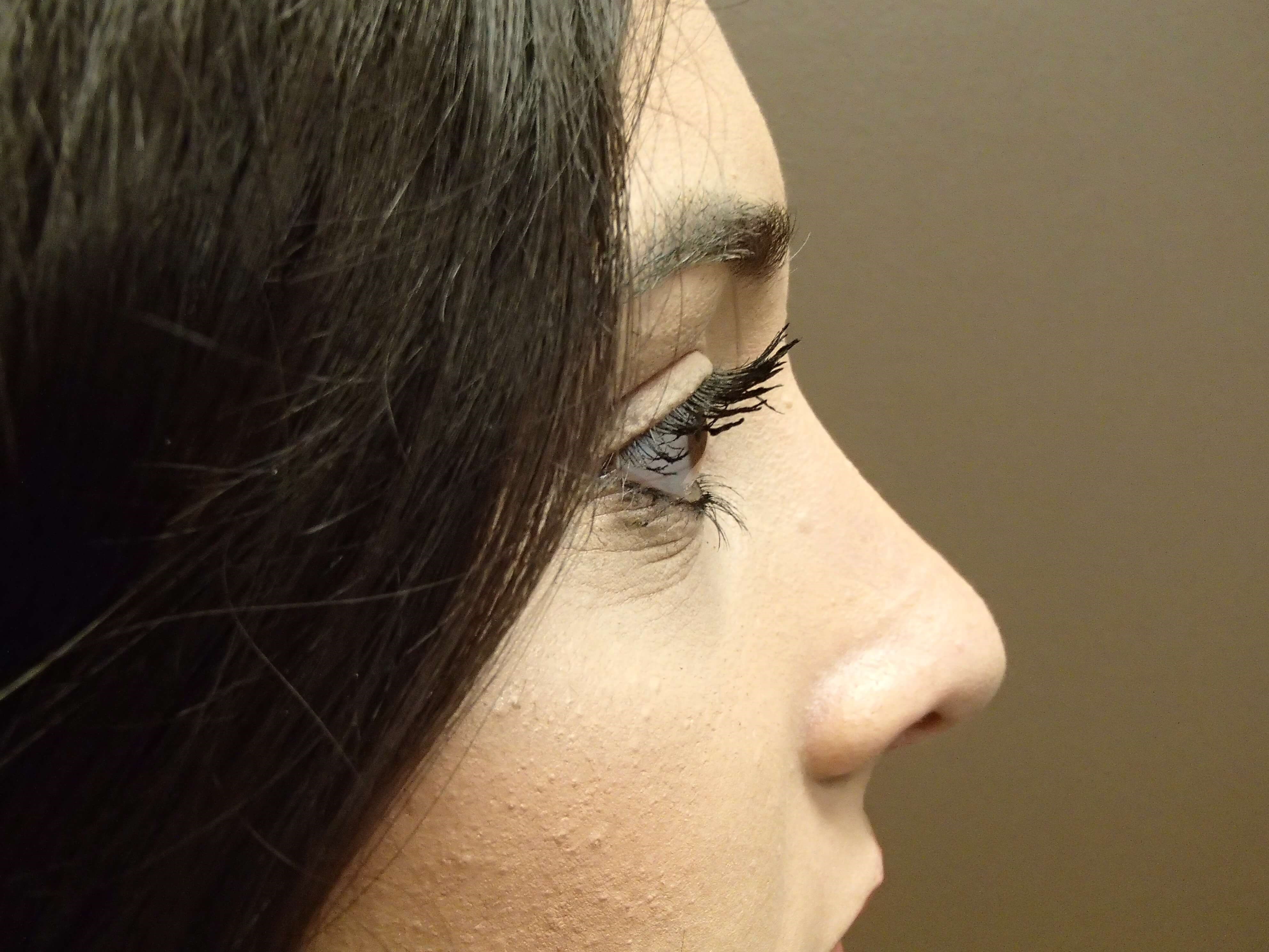Rhinoplasty (nose job) After