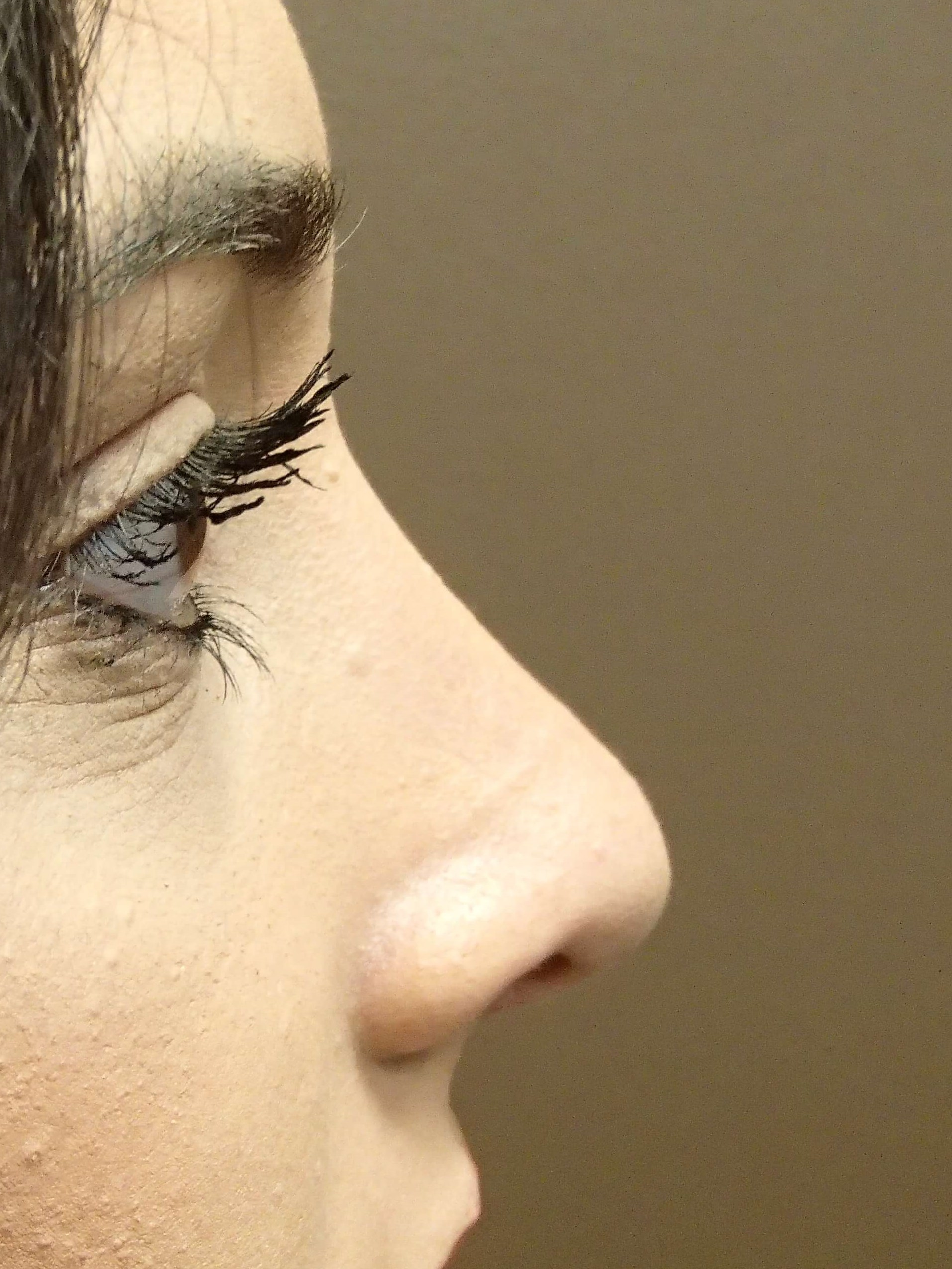 Rhinoplasty (nose job) After