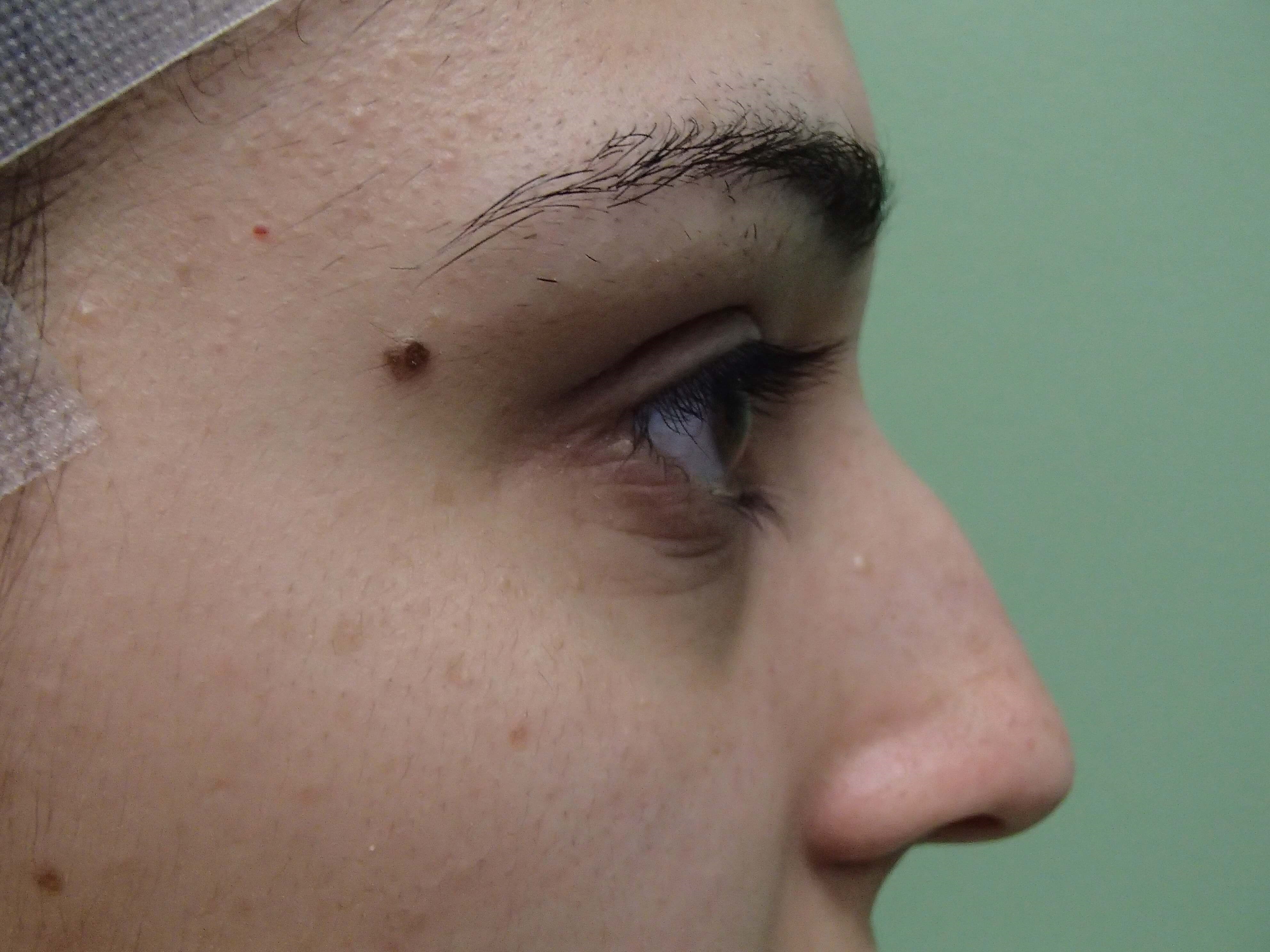 Rhinoplasty (nose job) Before