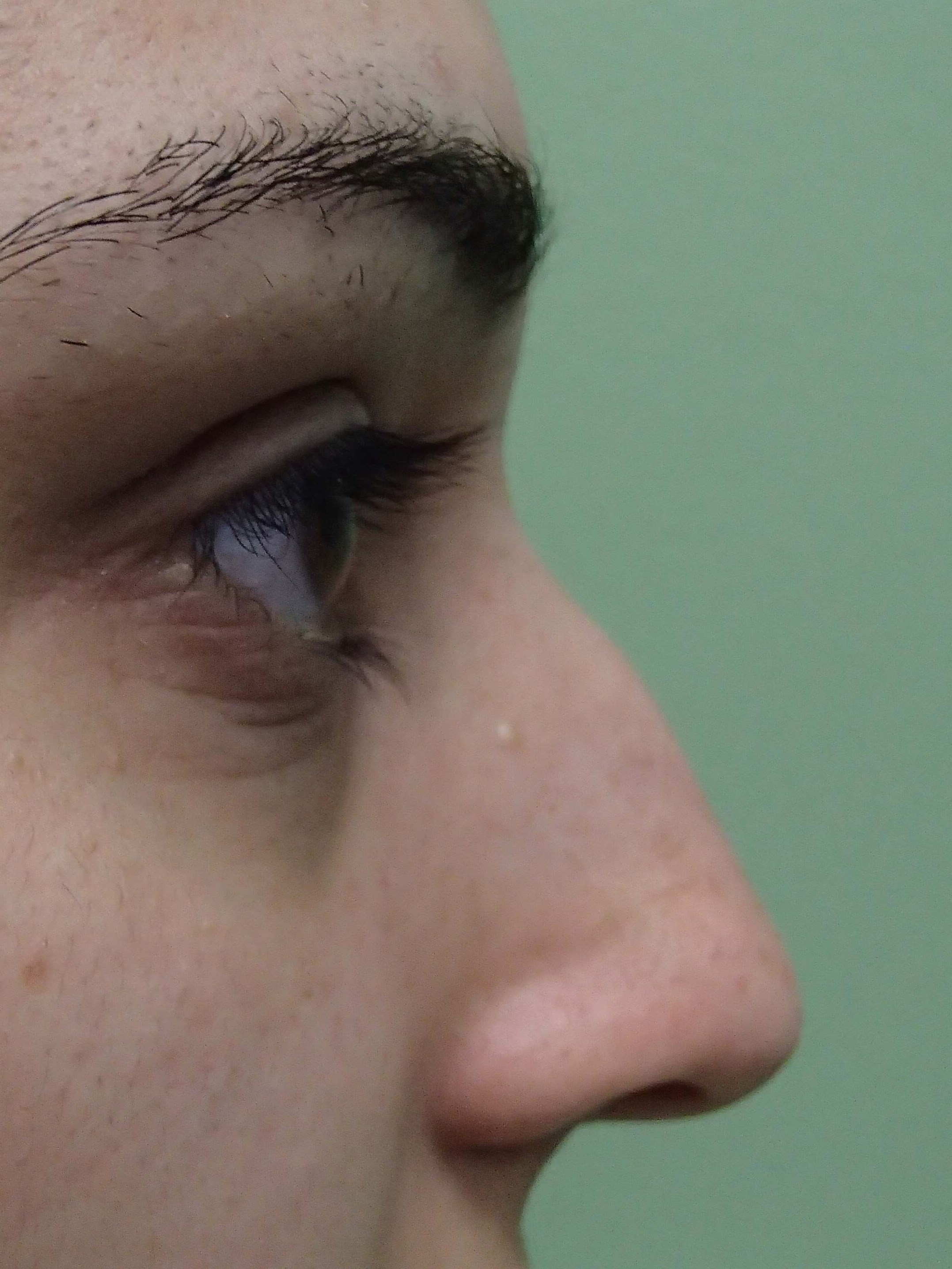 Rhinoplasty (nose job) Before