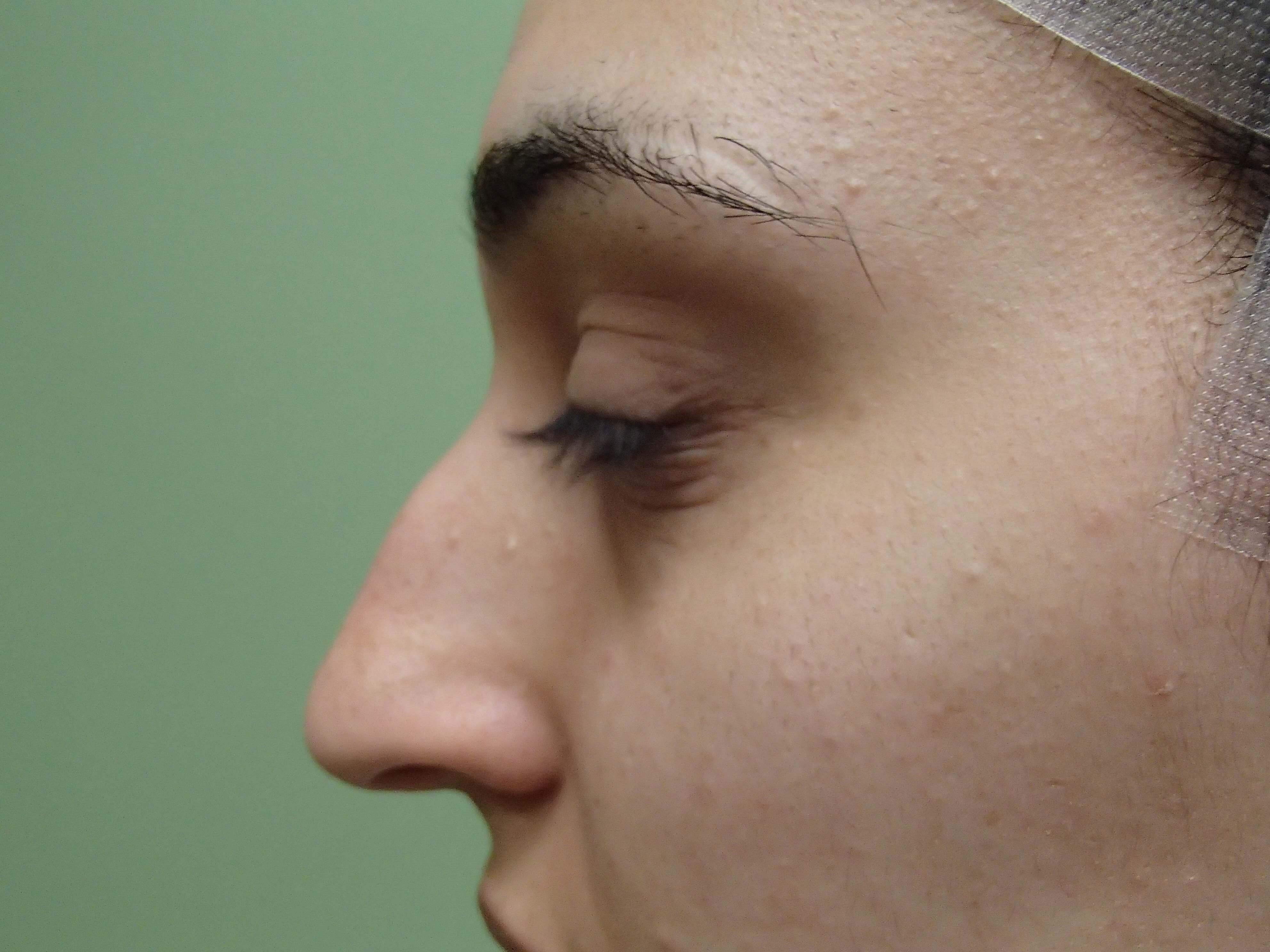 Rhinoplasty (nose job) Before