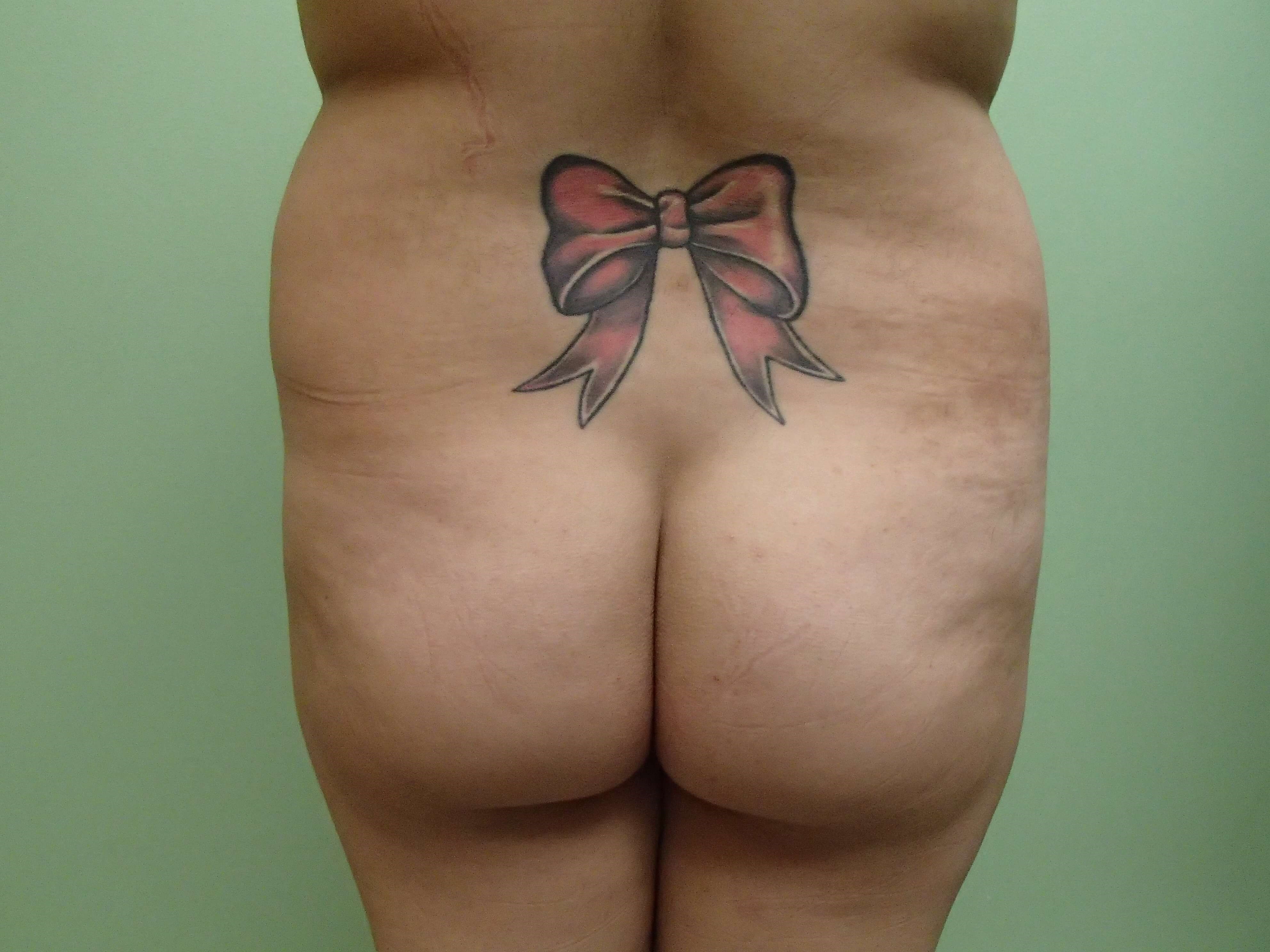 Brazilian Butt Lift (BBL) Before